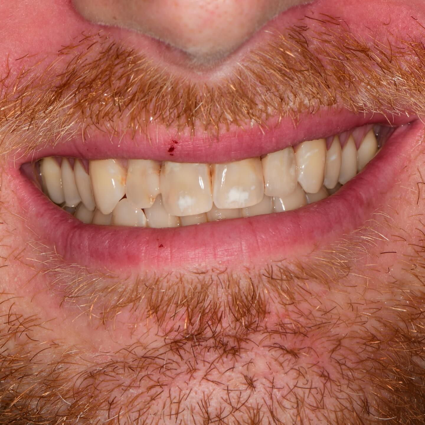 Which tooth wears the crown?
Another phenomenal restoration, from our ceramists at @precisionestheticsdentallab for a well pleased @drpaulmelchiorre over in Palm Beach.
When the note ends with << very happy doctor and patient >> 😊 we’ve done our job.
And the answer was number 10. That is the crown. 🙌
#notDowningStreet #TheCrown #notOnNetflix