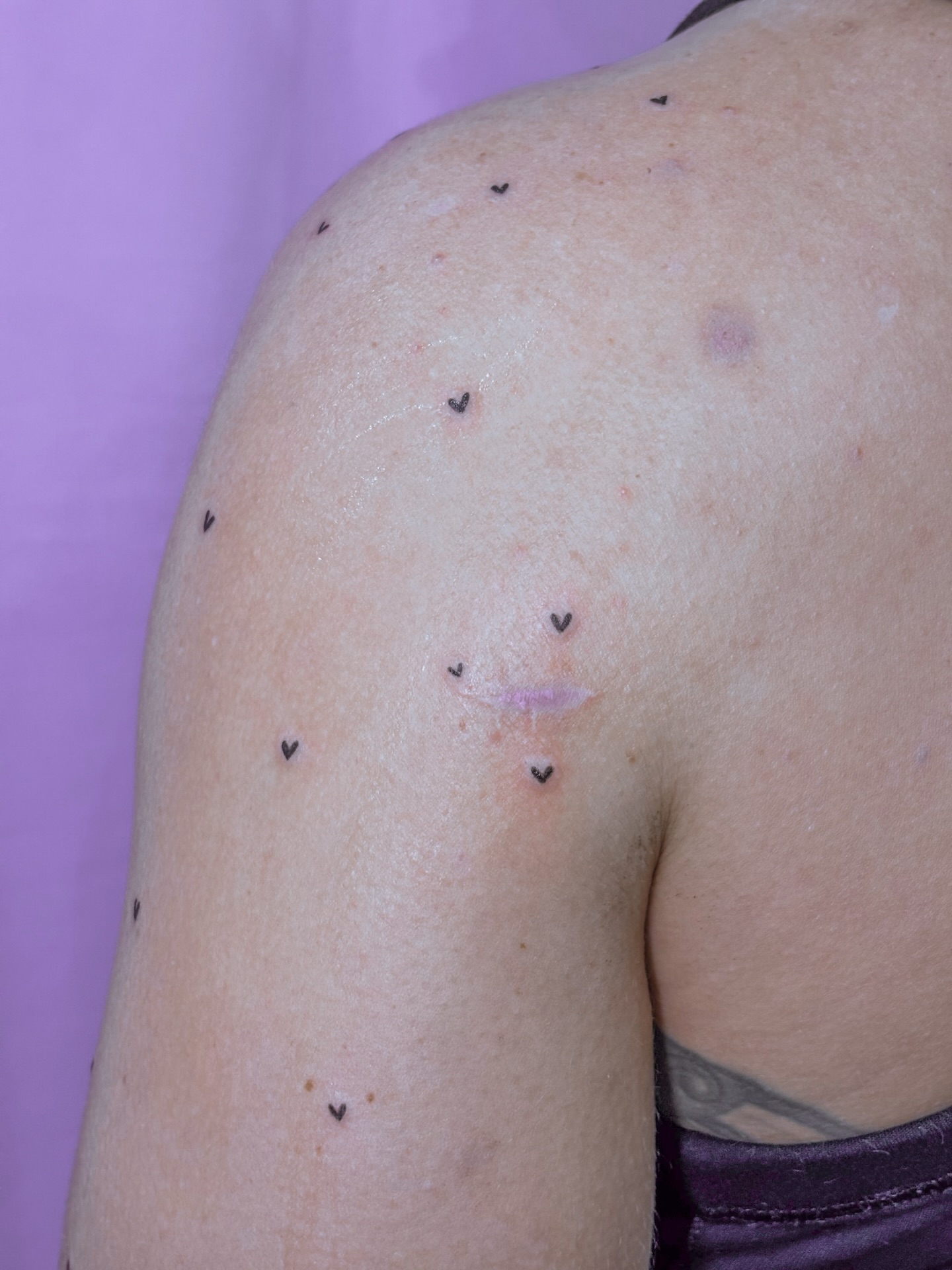 Mini corações para ressignificar. A Cora sofreu um acidente, que deixou algumas marcas pelo corpo. E então decidiu enfeitá-las para lembrar que ainda está aqui 💕