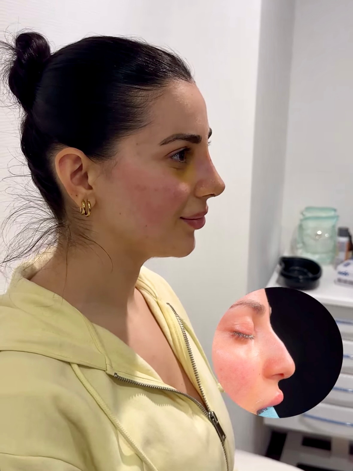 Előtte–utána: 1 hét orrplasztika után🫶🏼
A korai gyógyulási fázisban a duzzanat még látható, a forma a következő hónapokban tovább finomodik. A végleges eredmény általában 6–12 hónap alatt alakul ki.
📩 Kérdésed van a folyamatról vagy a beavatkozásról? Írj nekünk privátban vagy jelentkezz konzultációra!
#esteworld #esteworldmagyarorszag #orrplasztika #piezo #nosejob #rhinoplasty