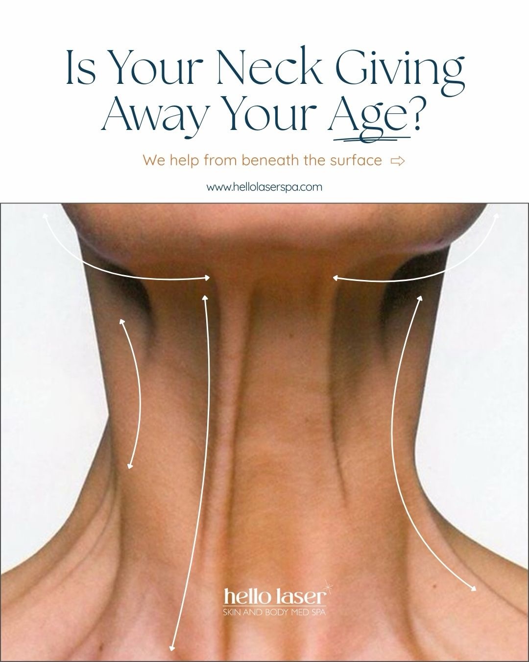 Is your neck giving away your age? The neck and jawline are often the first places to show skin laxity, fine lines, and collagen loss. As early as our mid-20s, collagen production begins to decline, which can lead to sagging skin over time.
At Hello Laser Skin & Body Med Spa, we offer non-invasive treatments designed to stimulate collagen beneath the surface and improve overall skin firmness and texture.
Treatments that may help include:
• Sofwave Skin Tightening – helps stimulate collagen to support firmer-looking skin
• SkinPen Microneedling – improves texture and encourages natural collagen production
• PicoWay Laser Facial – helps improve tone, clarity, and overall skin quality
✨ The best treatment plan starts with a personalized consultation so we can recommend what’s right for your skin.
📍 Tempe | Scottsdale | Biltmore
📲 Book your consultation online or call us to schedule.
☎️ 480-905-3080
Click link in bio to schedule online!🗓️
#necktightening #skintightening #collagenstimulating #sofwave #skinpenmicroneedling picowaylaser medspaaz scottsdalemedspa tempemedspa biltmoremedspa arizonamedspa noninvasiveskintightening hellolaser