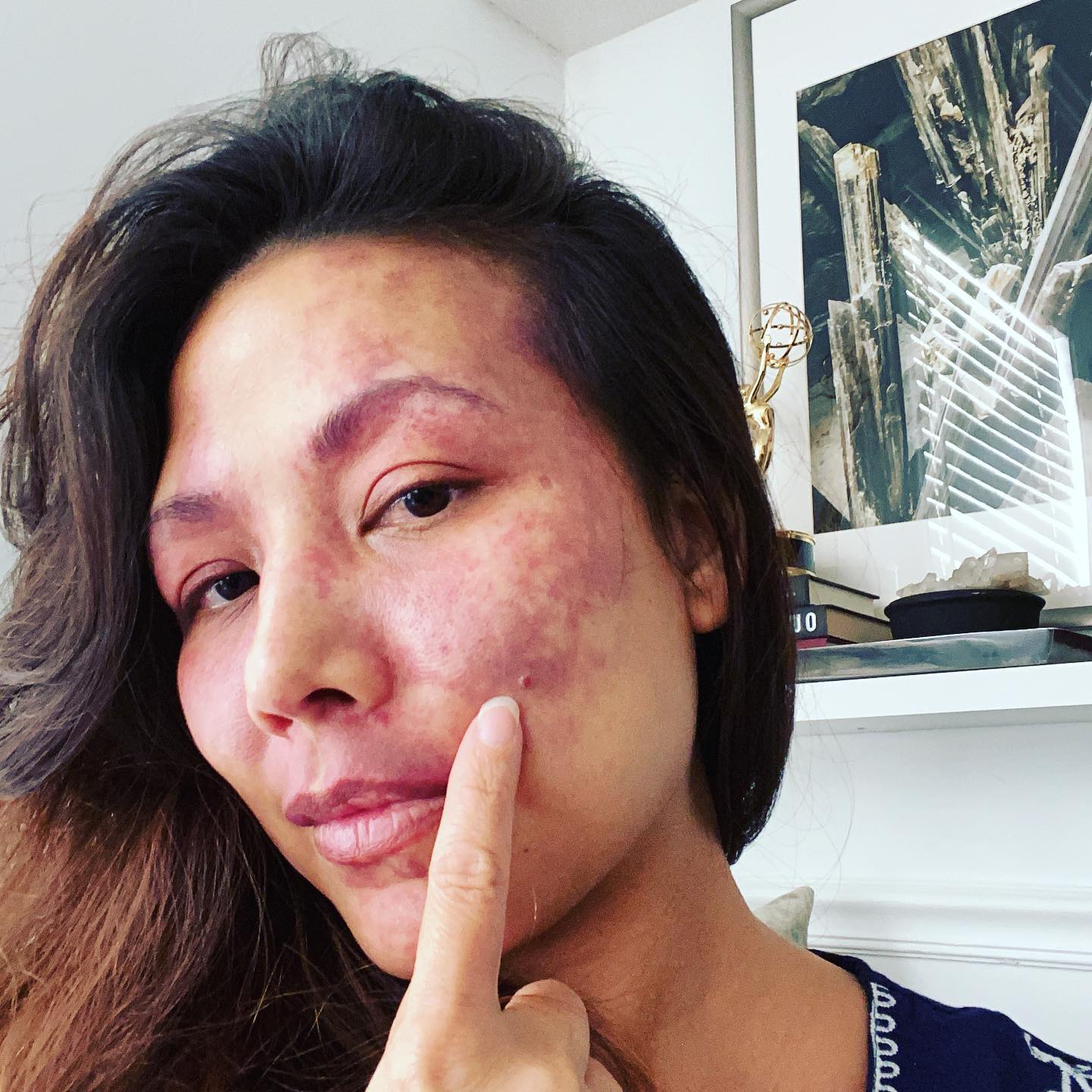 This is a “bleb” . With Port Wine Stains blebs can develop more and more as you age.
During my first pregnancy I developed on on my chin that ruptured and would not stop bleeding without being cauterized
When it healed it caused a large hypotrophic scar 😐
Blebs are difficult to deal with because of the shear amount of blood vessels behind them. When hit with lasers they rarely dissipate and can widen . These are my beauty marks 😉. Tell me about yours! #pwsstrong #pws #portwinestain #portwinestainbirthmark #sturgeweber #sturgewebersyndrome #pulsedyelaser #pulsedyelasertreatment