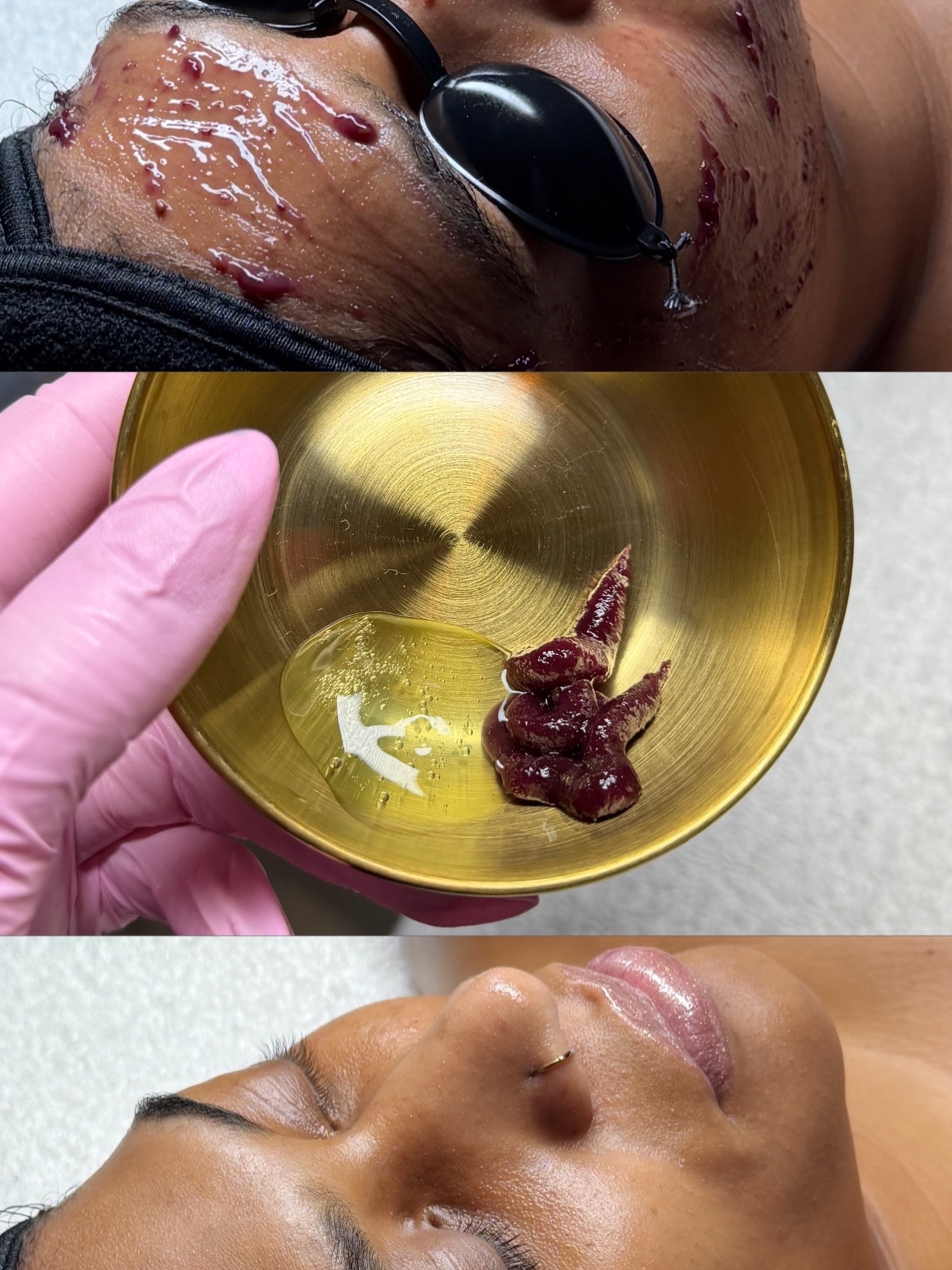 A Favorite Duo in the treatment room
Triple berry smoothing peel 𝘅 O2 Gel
Glow by @aestheticsbyilyana