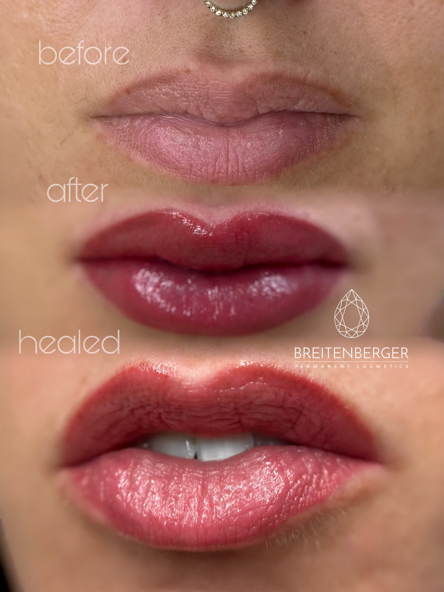 Wow… ich liebe solche Veränderungen einfach!
Mit Permanent Make-up kann man selbst dunkleren, bräunlichen Lippen wieder richtig Frische und Leuchtkraft schenken. Hier seht ihr die ganze Transformation. Vorher - direkt danach und das abgeheilte Ergebnis nach nur einer Behandlung – ganz natürlich, aber mit so einem schönen Unterschied.
Meine Kundin hat mir bei der Farbauswahl komplett vertraut (davon bitte wirklich mehr 😁) und mir freie Hand gelassen. Ich finde, wir haben den perfekten Ton getroffen.
Die Lippen wirken jetzt viel weicher, frischer und harmonischer. Und das Schönste: Das ganze Gesicht strahlt plötzlich mehr, weil die Lippen nicht mehr fahl aussehen, sondern lebendig und gesund.
PS: frisch pigmentiert sieht die Farbe um einiges kräftiger aus, das ist nur ca. 3-4 Tage so.
PMU LIPS
PERMANENT MAKE UP