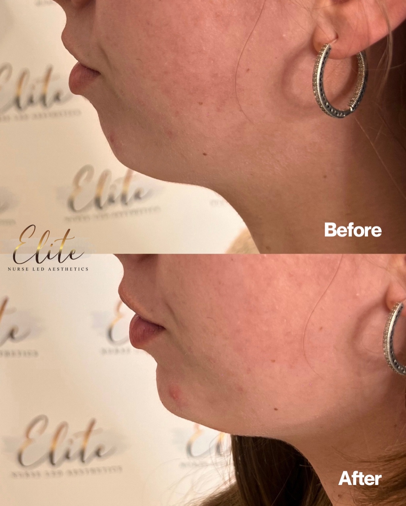 ✨ It’s not about changing your face — it’s about balancing it ✨
Chin filler is one of the most powerful ways to enhance your side profile and bring harmony to your facial features.
By adding structure and projection, chin filler helps create a more defined jawline, improve facial proportions, and subtly enhance your overall profile.
💎 Benefits of chin filler for profile balancing:
✔ Enhances chin projection and shape
✔ Improves facial symmetry and balance
✔ Defines the jawline
✔ Creates a stronger, more harmonious side profile
✔ Delivers natural-looking, long-lasting results
Small adjustment. Big confidence boost.
📍 Elite Nurse Led Aesthetics – Wakefield
💬 Thinking about profile balancing?
Book your consultation today and let’s create subtle, balanced results ✨
#EliteNurseLedAesthetics #WakefieldAesthetics #ChinFiller #ProfileBalancing #FacialHarmony