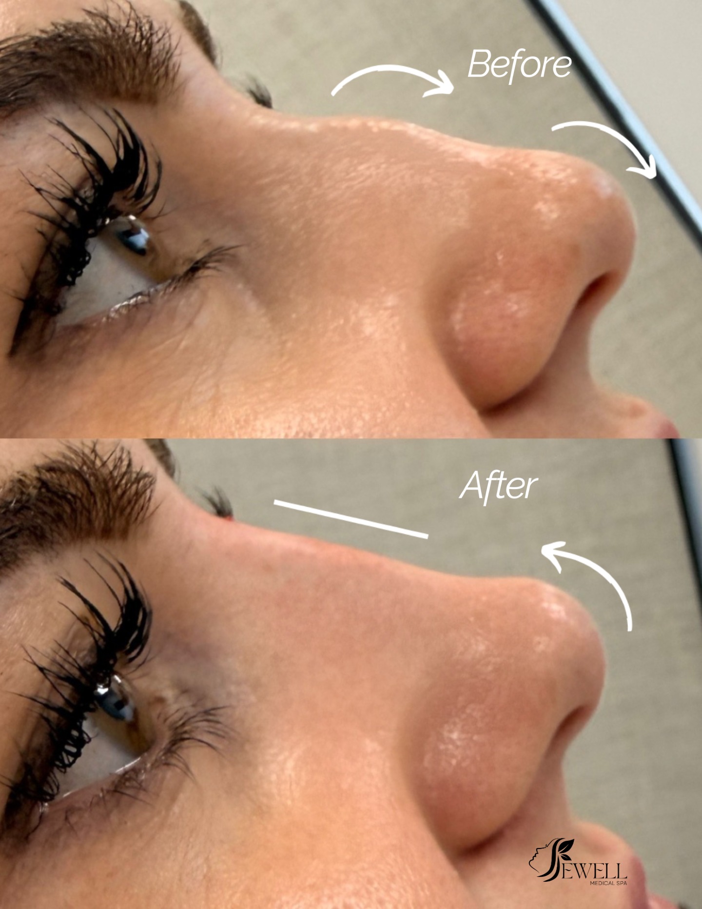 Refined, balanced, and beautifully natural ✨ Liquid rhinoplasty—no surgery, just confidence.
Call or text today to book your appointment!
☎️ 239-448-3383
📩 chris.jewell@jewellmedicalspa.com
🌐 www.jewellmedicalspa.com | www.mrinjectable.com
📍 1044 Castello Drive, Ste 213 Naples Florida 34103
💳 We Accept Care Credit!
*
*
*
#naples #naplesfl #injectables #liquid #rhinoplasty #sculpt #define #youthful
#radiant #nose #confidence #cosmeticinjectables #aesthetics #beauty #naplesbeauty #naplesinjector #medspa #bestaestheticinjectors #beforeandafter