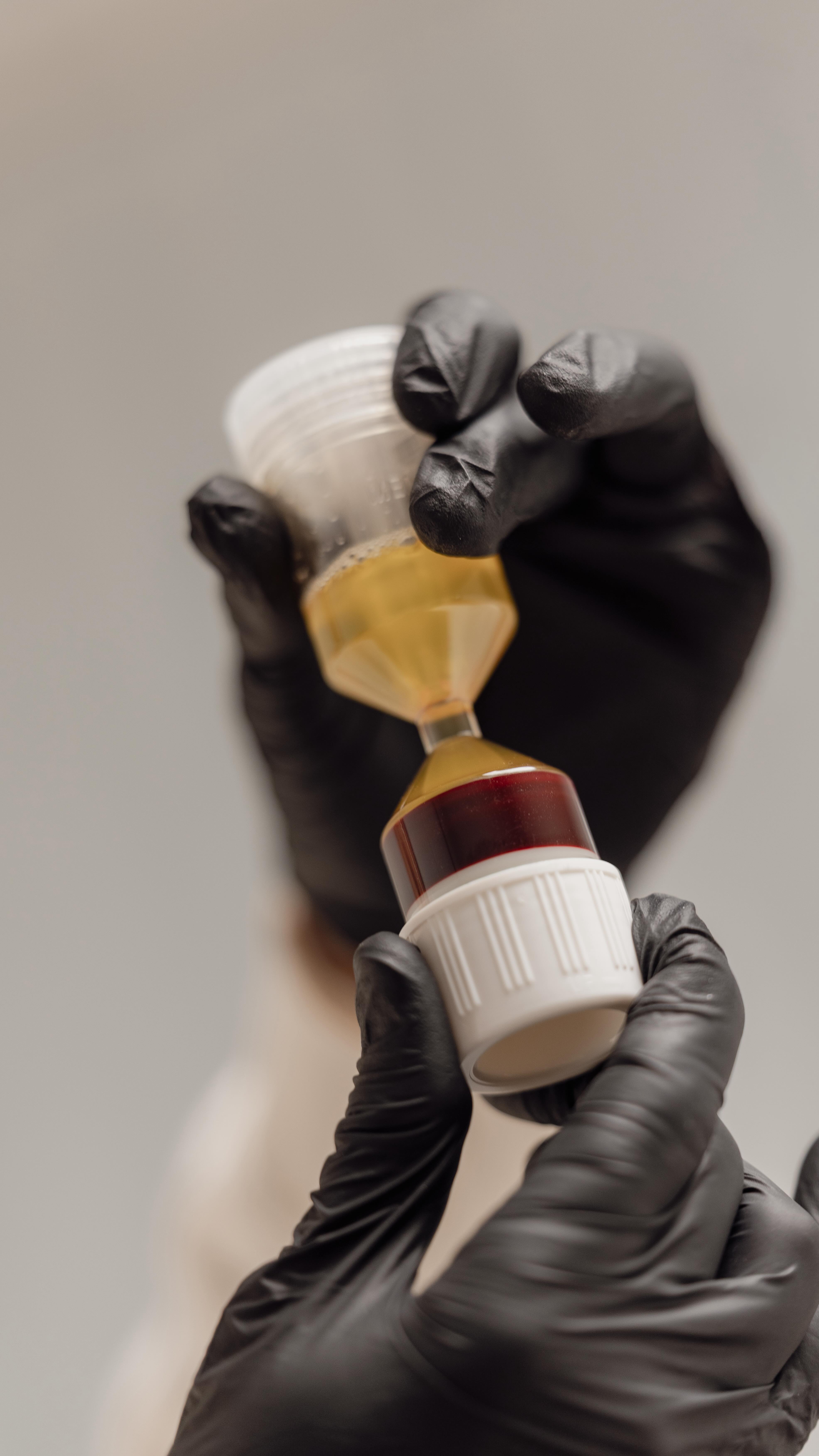 Blood plasma is obtained by separating whole blood that has been mixed with an anticoagulant in a centrifuge.
At approximately 2000 g for at least 15 minutes, the solid components (cells) settle at the bottom, while the plasma remains as a clear, yellowish supernatant at the top and can be removed.
•
•
Blutplasma wird gewonnen, indem man Vollblut, das mit einem Gerinnungshemmer versetzt wurde, in einer Zentrifuge trennt. Bei ca. 2000 g für mindestens 15 Minuten setzen sich die festen Bestandteile (Zellen) am Boden ab, während das Plasma als klarer, gelblicher Überstand oben bleibt und abgenommen werden kann
#bloodplasma #prp #prptreatment