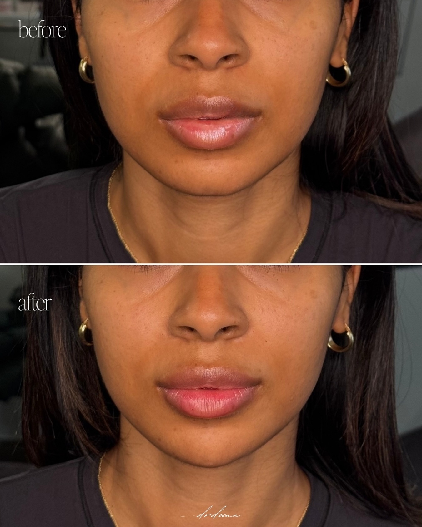 CHIN & LIPS
At Dr Deena Aesthetics, our lip and chin injectable treatments are designed to restore harmony and proportion.
Dermal fillers can:
• Enhance lip definition and hydration
• Improve chin projection and profile balance
• Support overall facial symmetry
Every treatment begins with a detailed consultation, prioritising facial anatomy, safety, and long-term aesthetic strategy.
Our approach is refined, conservative, and tailored to each patient’s unique structure.
Thinking about injectables but unsure where to start? A consultation is the best place to begin. You can book your via the link in the bio.
👩🏻⚕️Dr Deena Roye
💉Injectables
📍15 Percy St, London W1T 1DS, United Kingdom
✉️info@drdeenaaesthetics.com
📱Whatsapp -07776 454541
· · · · · · · · · · · · ·
#drdeenalondon #aestheticslondon #injectableslondon #medicalaesthetics #clinicalresults