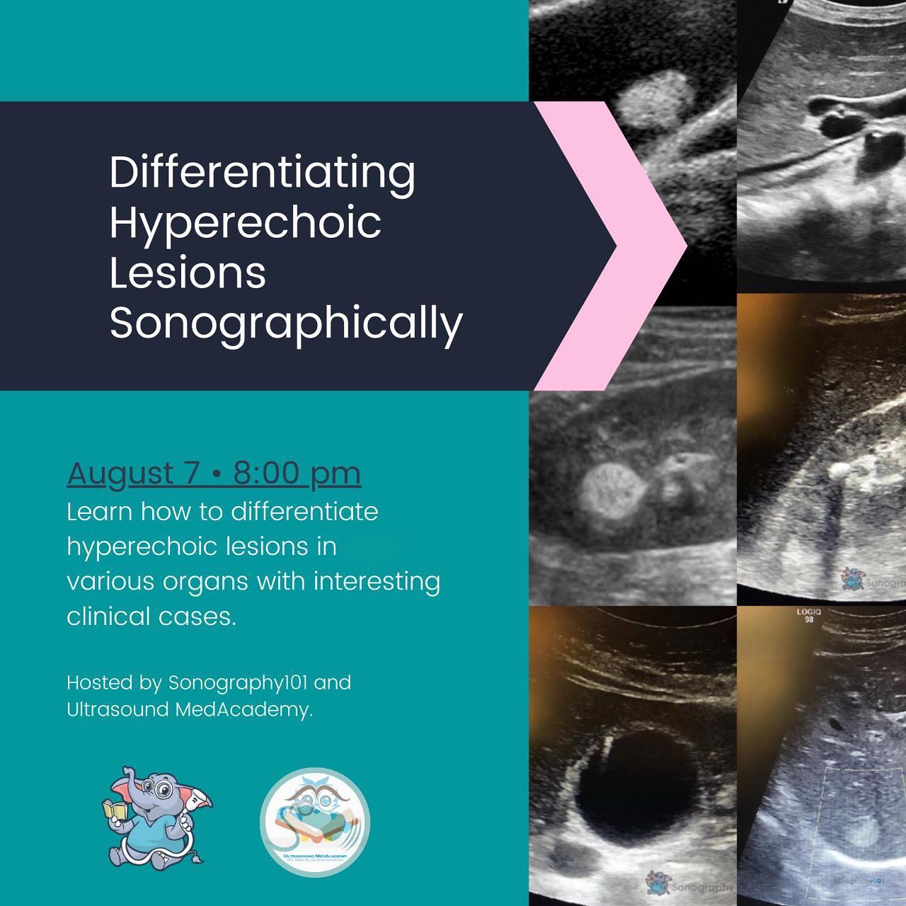 For those of you that didn’t have the opportunity to attend our free webinar this past Friday on how to differentiate echogenic lesions sonographically. We have uploaded it to Ultrasound MedAcademy’s Youtube Channel!
We will be bringing you guys A LOT more of this 😁
Drop your topic requests down below and we will add it to our list!
LINK IN BIO 📌
.
.
.
.
#ultrasound #sonography #medicalsonography #RDMS #RVT #RegisteredDiagnosticMedicalSonographer #RegisteredVascularTechnologist #UltrasoundTechnologist #Sonographer #UltrasoundTech #Sonography101 #ultrasoundED #ultrasononography #ultrasonographer #Medicine #Medical #Radiology #Radiologia #Ultrasonido #DiagnosticImaging #Medicina #Sonograma
#sonographystudent #sonographyschool