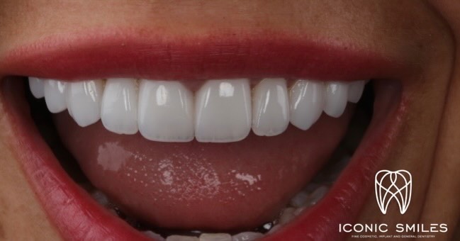 🌟Porcelain Veneers 🌟
Porcelain veneers are not all the same! We have added natural details to the veneers and a glass like finish to the veneers to finish with this rejuvenating smile.
DISCLAIMER
All information provided by Dr Matthew El Azzi - DEN0001996783, Registered Dentist, is for general and educational purposes only. It does not constitute medical advice and should not be relied upon as a substitute for professional consultation.
Images and videos are of real patients who have given consent. No filters, AI enhancements, or unrealistic lighting are used. These materials are intended to demonstrate examples of treatment but do not guarantee results. Individual results, risks, potential complications, and recovery times vary between patients.
Patient stories are individual experiences and should not be interpreted as indicative of expected outcomes for all patients. Your experience may differ.
Before commencing any treatment, you should seek independent advice from a qualified, AHPRA-registered health practitioner and consider obtaining a second opinion.
For details about each specific treatment, head to:
https://www.iconicsmiles.com.au
Dr Matthew El Azzi - DEN0001996783
Registered Dentist, General Registration