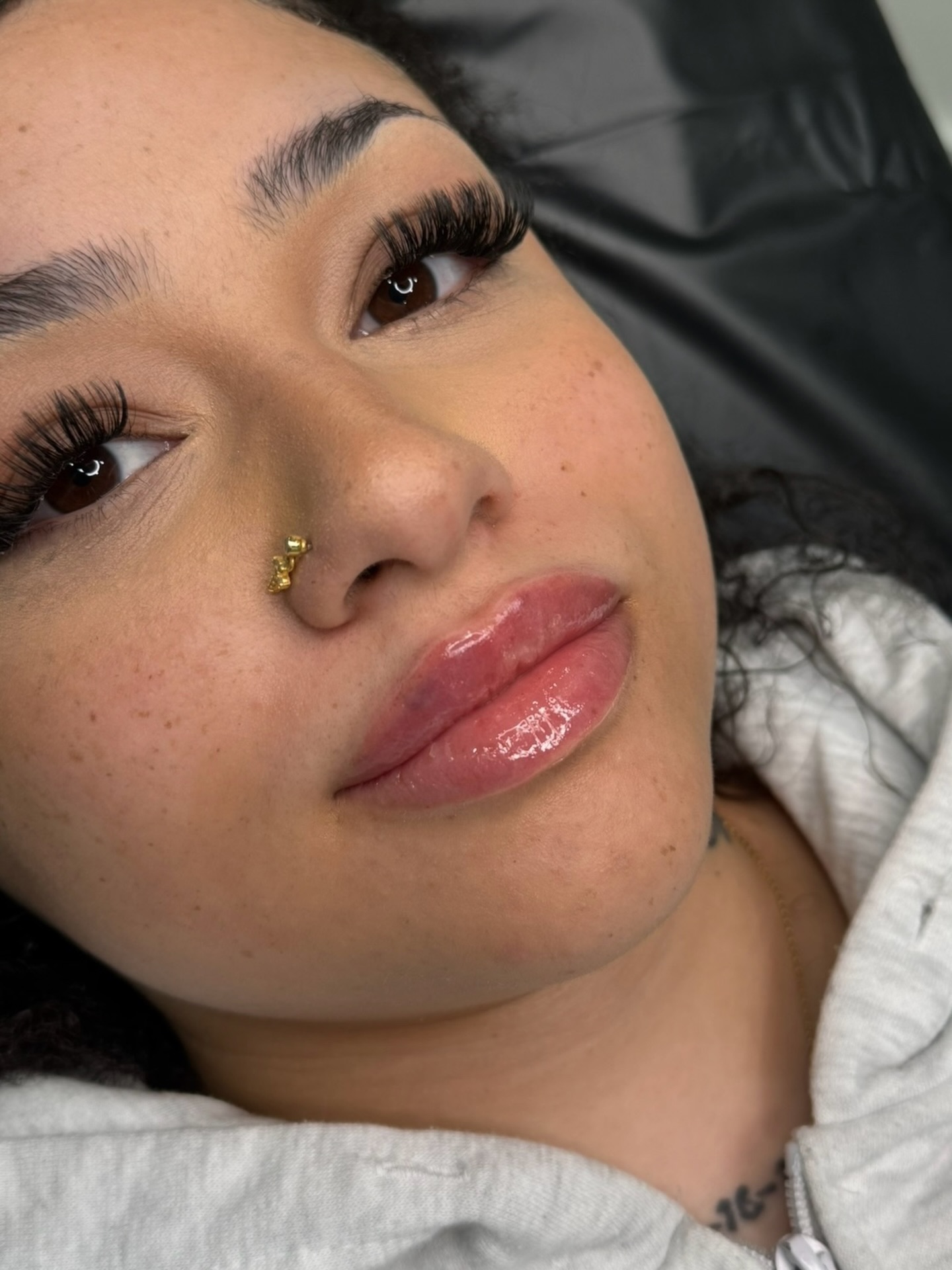 Treatment: Lip Filler Treatment using Hyaluronic Acid
For more information or to book a consultation, contact us:
📱 343-451-7141
✉️ infoshaybloo@gmail.com
Video and photos were taken immediately after treatment. Redness and swelling are normal and will subside within a few days, with final results visible in about two weeks. Please note that lighting, angles, and skin tone can vary slightly in photos, but the focus is on the progress achieved.
#filler #ottawa #nurseinjectorottawa #toronto #lips