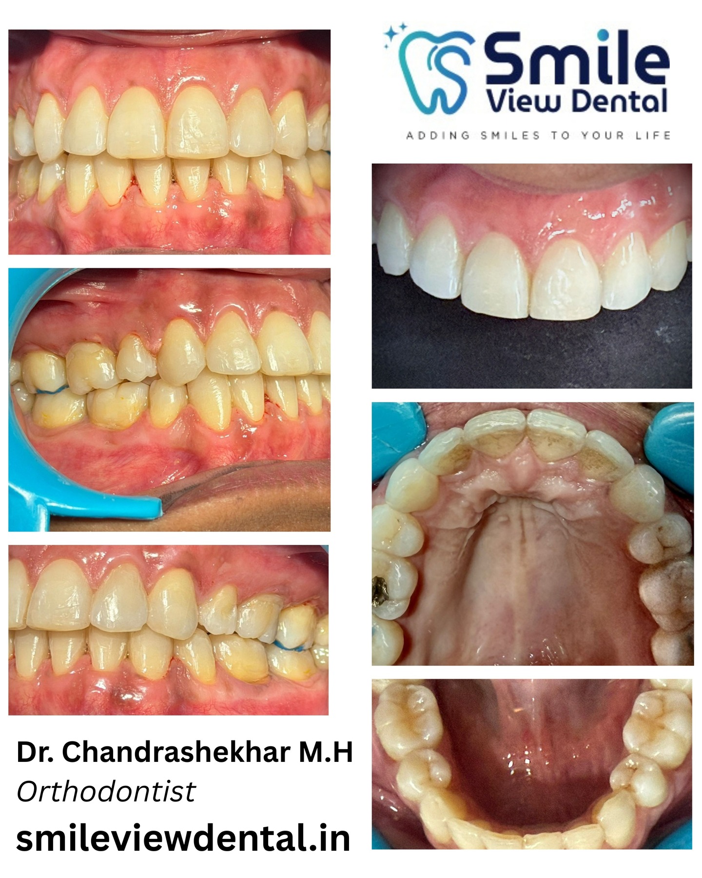 Straighten Your Smile with Expert Orthodontic Care! 😁🦷
Crooked teeth, spacing, or bite issues can affect not just your smile but also your overall oral health. With the right orthodontic treatment, you can achieve a healthy, well-aligned, and confident smile.
At Smile View Dental, Dr. Chandrashekhar M.H (Orthodontist) provides advanced orthodontic solutions designed to correct alignment and improve your bite for long-term dental health.
✨ Benefits of Orthodontic Treatment:
✔ Straighter and more confident smile
✔ Improved bite and chewing function
✔ Better oral hygiene and gum health
✔ Long-term dental stability
Start your journey toward a perfect smile today!
🌐 www.smileviewdental.in
#SmileViewDental #Orthodontics #BracesTreatment #SmileTransformation #HealthySmile #BangaloreDentist #Orthodontist #DentalCare #StraightTeeth #ConfidentSmile