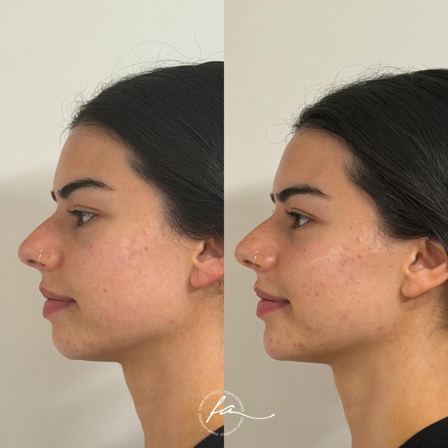 Comprehensive assessment for profile concerns.
This patient presented with concerns regarding her side profile. A full facial consultation was performed, assessing skeletal structure, soft tissue distribution, and facial proportions from both frontal and lateral views.
Treatment was directed at structural support in the midface and chin to address projection and lower face balance, with careful consideration of maintaining her natural facial characteristics.
Images are shared with patient consent. Individual results vary. A consultation is required to determine suitability. All medical procedures carry risks and potential side effects which will be discussed prior to treatment.
Stephanie Sirillas, RN
AHPRA Registered Nurse
Forme Aesthetics
