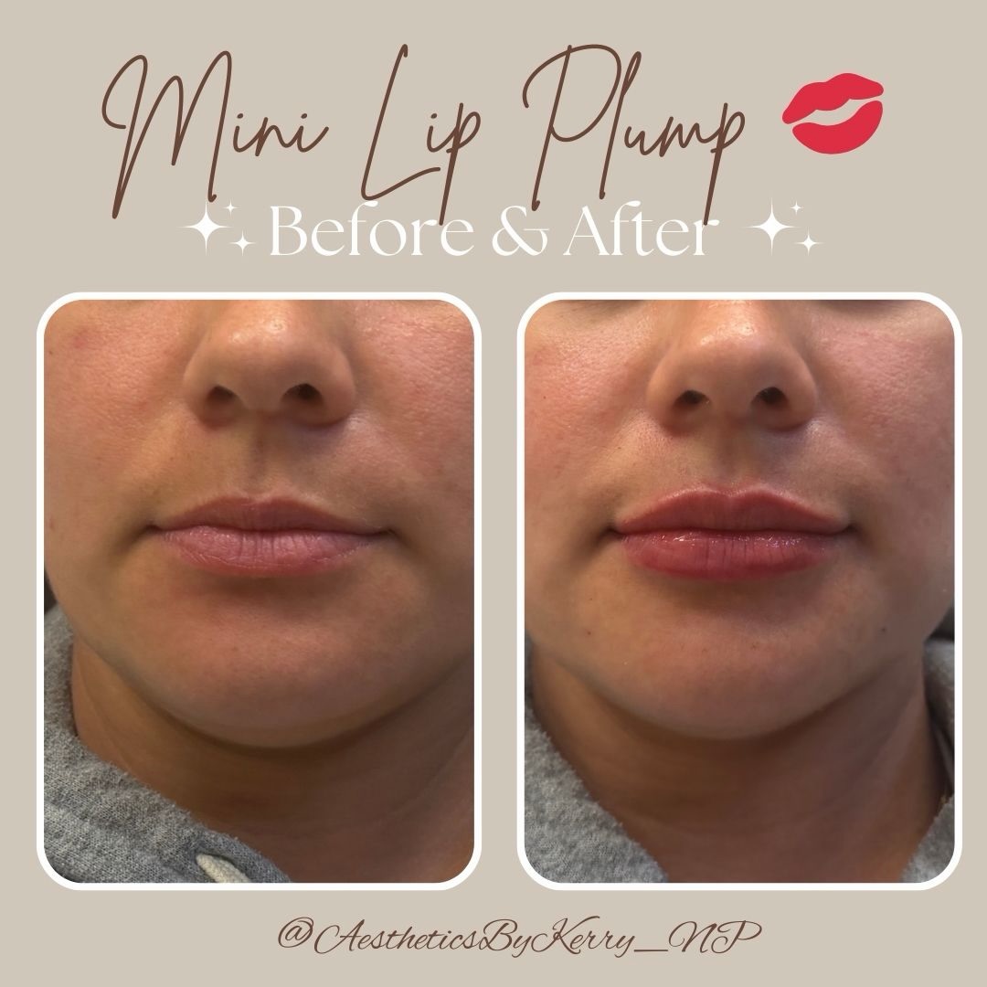 Beautiful before. Refined after.
Lip filler isn’t always about creating new lips, it’s about enhancing what already makes you unique. Soft volume, balanced proportions, and confidence that still feels like you.
Save this for your lip goals and click the link in bio to schedule your session! 💋
.
.
.
#lipfillerbeforeandafter #lipaugumentation #injectables #southfloridamedspa #evolyssesmooth