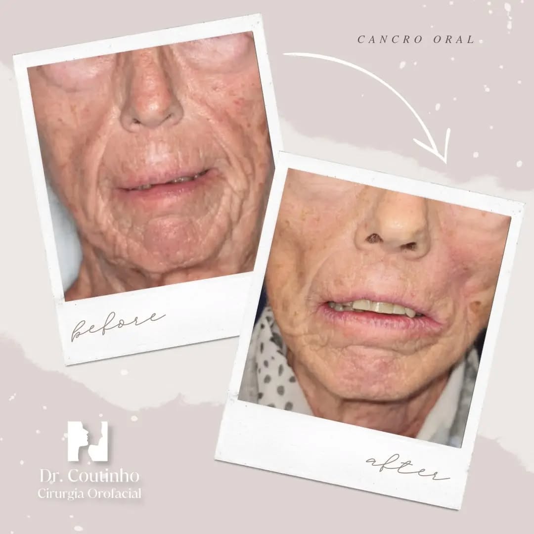 Superação e Renovação:🕊️
Vencer o cancro não é fácil, mas é possível. É uma luta difícil e injusta porque o cancro não respeita limites. Por isso, quando tratamos o cancro temos que remover de forma radical, com margens amplas que garantam que removemos todas as células malignas.
Neste antes e depois mostramos uma vitória contra o cancro oral. E para isso também são fundamentais a reconstrução e a reabilitação dentária.
Trata-se de devolver a auto-estima da pessoa. Ir além da cura física, restaurar a fala, a mastigação e a dignidade na interação social.
Cada sorriso reflete uma história de resiliência e esperança.
Cirurgia:
- Esvaziamento cervical (Dra. Ana Rita Santos, ORL)
- Ablação (Dr. José Coutinho)
- Reconstrução (Dr. Gonçalo Coutinho)
Reabilitação oral: Drs. Coutinho
#Renascimento
#VidaApósCancro
#Resiliência