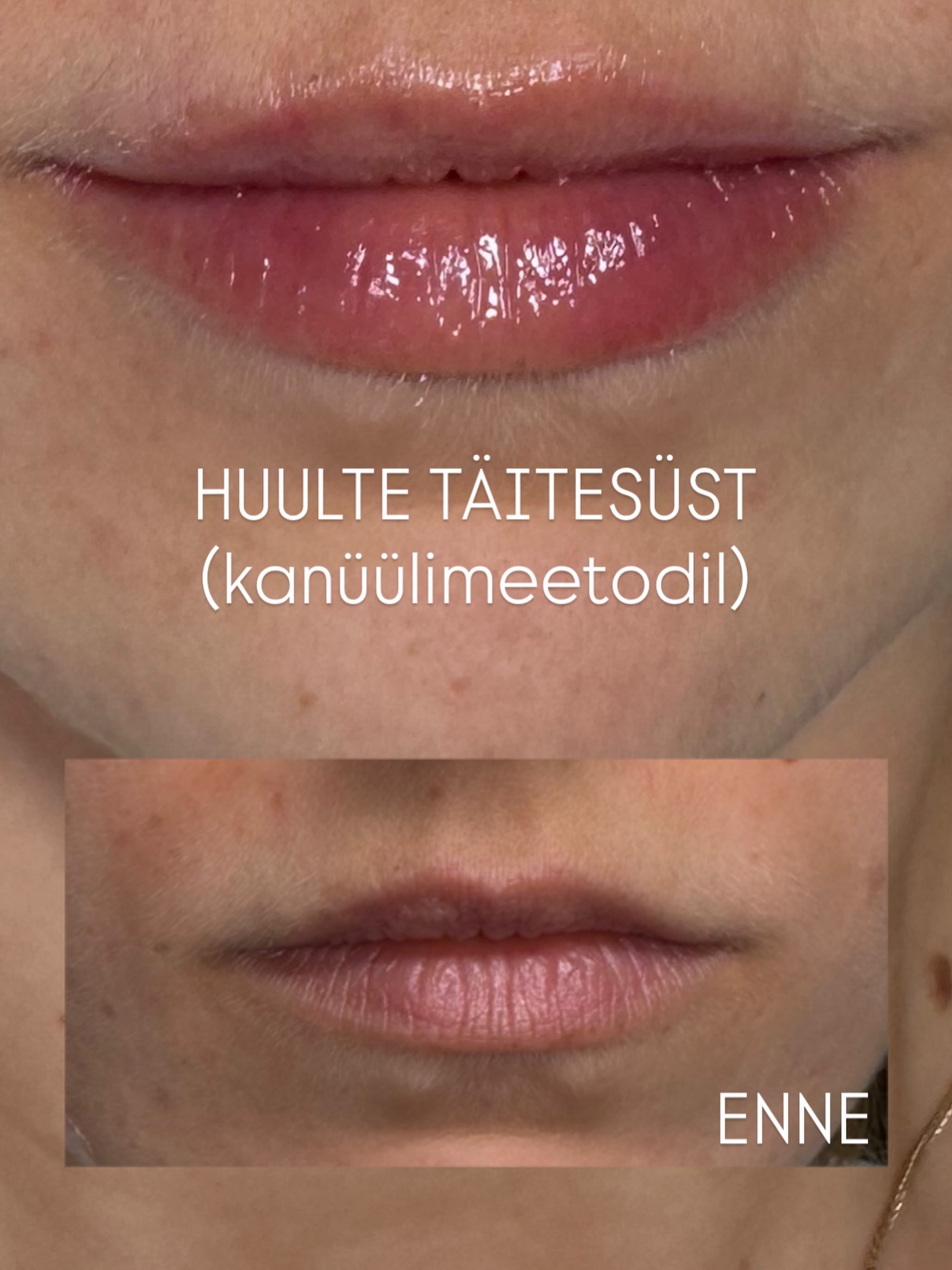 Huulte täitesüsti eesmärk ei ole muuta inimest kellekski teiseks. ✨
Selle mõte on tuua delikaatselt esile see, mis on juba olemas – sinu loomulik ilu, sinu eripära ja sinu enesekindlus.
Õigesti teostatud täitesüst ei karju, vaid täiendab.
See ei võta ära sinu nägu – see toob välja sinu parima versiooni.
Väikesed nüansid. Pehme tasakaal. Loomulik tulemus. 🤍
#huultetäitesüst #loomuliktulemus #ilusüstid #esteetilinemeditsiin #ilukliiniktartus