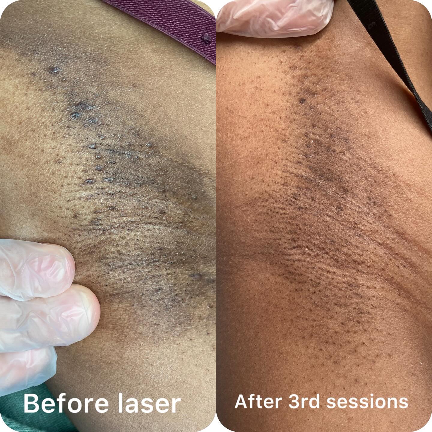 Zoom it to see the difference π€©
Are you ready for summer βοΈ?
Look at this amazing skin after 3rd sessions of laser hair removal.
Reducing of the hair, her skin is clear, less sporty, overall amazing skin improvement.
DM to book your laser session ππ
#laserhairremoval#aw3lasers#