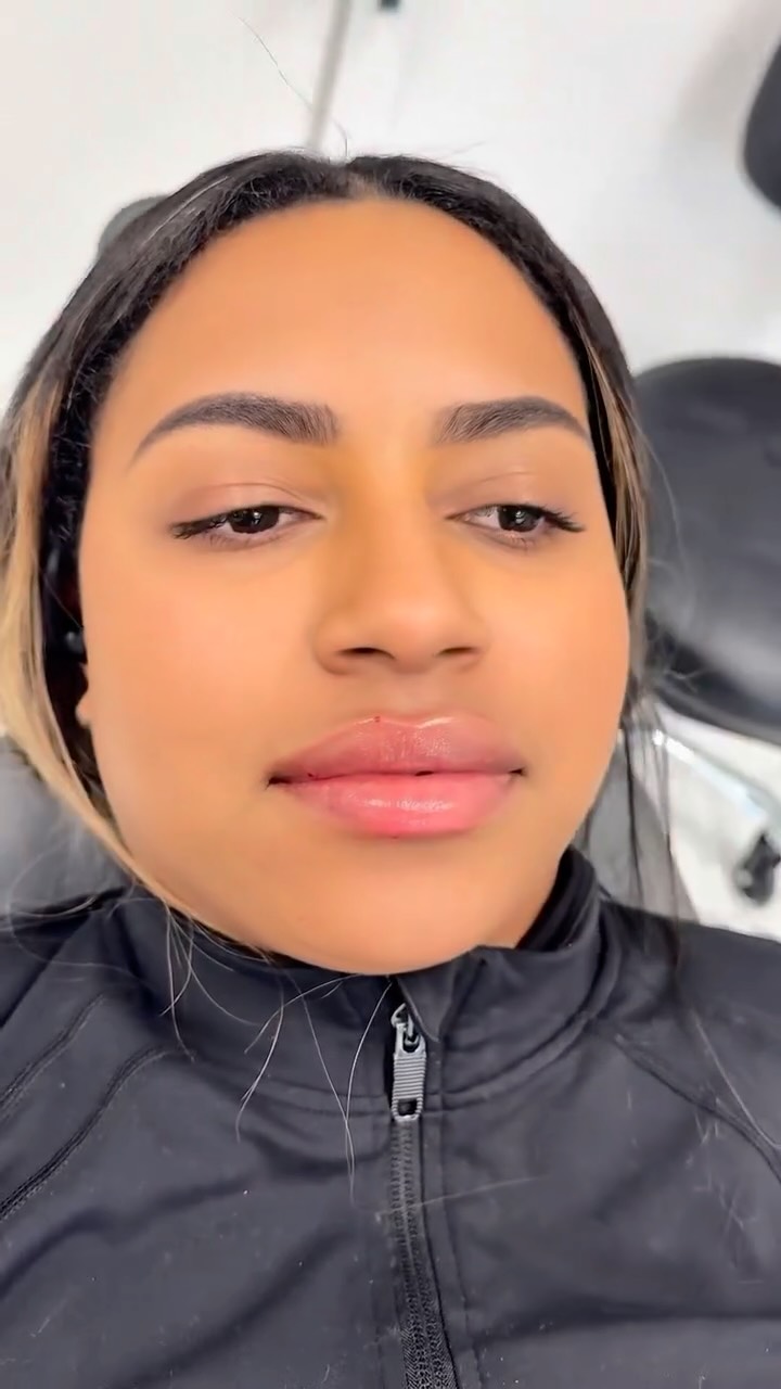 Fresh lips, subtle volume, instant confidence 💋
Not about changing who you are—just enhancing what you already have.
Soft. Natural. You, but elevated. ✨
Call or text today to book your appointment!
☎️ 239-448-3383
📩 chris.jewell@jewellmedicalspa.com
🌐 www.jewellmedicalspa.com | www.mrinjectable.com
📍 1044 Castello Drive, Ste 213 Naples Florida 34103
💳 We Accept Care Credit!
*
*
*
#lipfiller #lipfillers #lipaugmentation #lipplump #lipinjection #lipenhancement
#lipcontouring #restylanelips #injectables #dermalfillers #cosmeticinjectables #aesthetics #beauty #restylane #restylaneusa #naplesbeauty #naplesinjector #medspa #dolllips #lippies #bestaestheticinjectors #beforeandafter