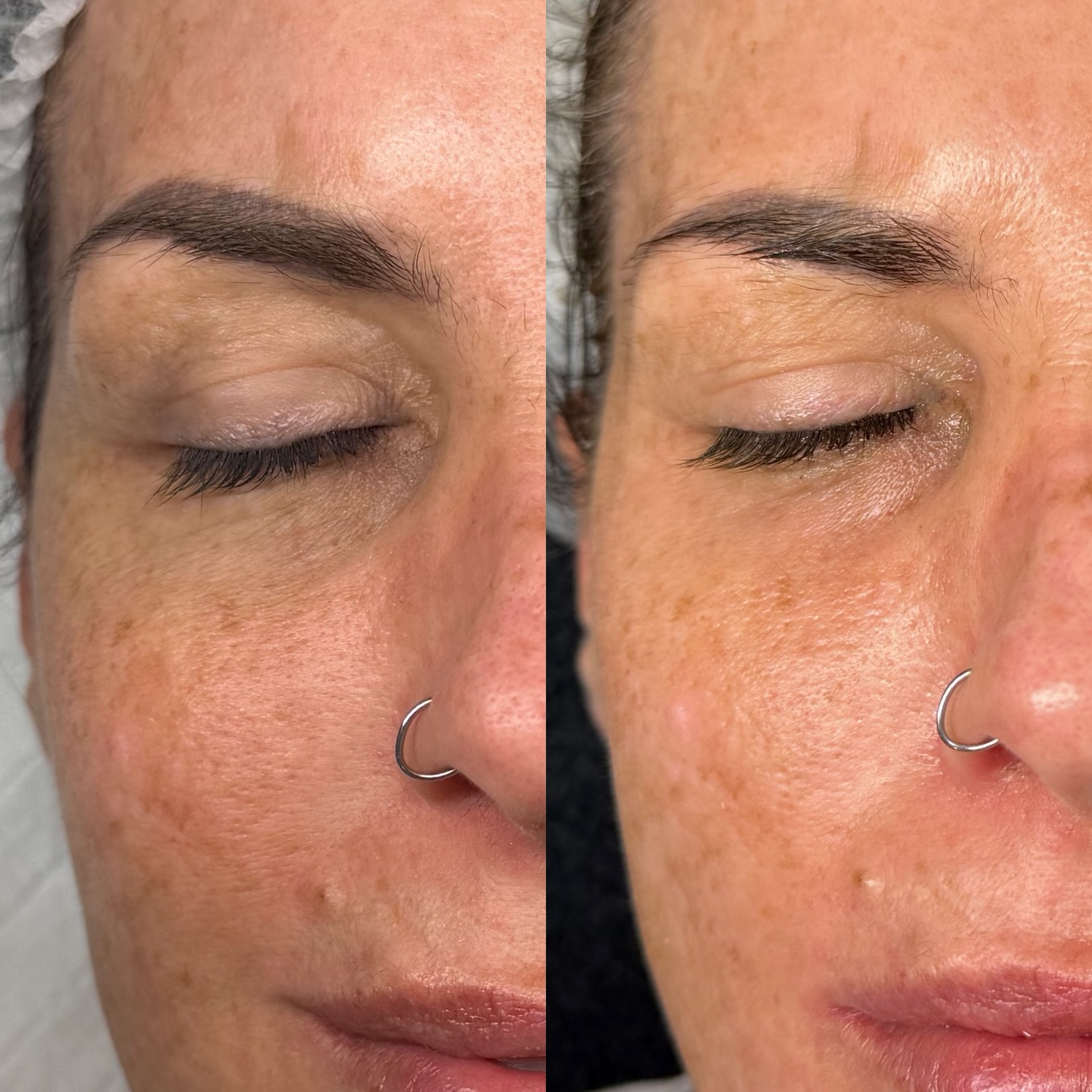 Real skin results from consistency 👏
This beautiful client has just completed her Ultimate Skin Reset with me - and the goal was simple: improve overall skin health, hydration and texture.
Her plan included:
• 2 x skin needling treatments
• 2 x Lift & Tone treatments
• Barrier focused skincare
Tailored skincare advice using ingredients that are incredible for strengthening the skin barrier, improving hydration and helping the skin function the way it should.
When we combine the right treatments with the right home care, this is when the magic really happens 😍
Her skin now looks:
• brighter
• more hydrated
• smoother in texture
• healthier overall
And the best part? These are realistic, skin-first results that aren’t overdone, just healthy skin doing what it’s meant to do.
Consistency always wins.
If you feel like your skin needs a reset, send me a message and we can create a plan for you too.
📲 ONLINE BOOKING 🔗 LINK IN BIO
www.containedbeauty.com.au
💙 AFTERPAY AVAILABLE