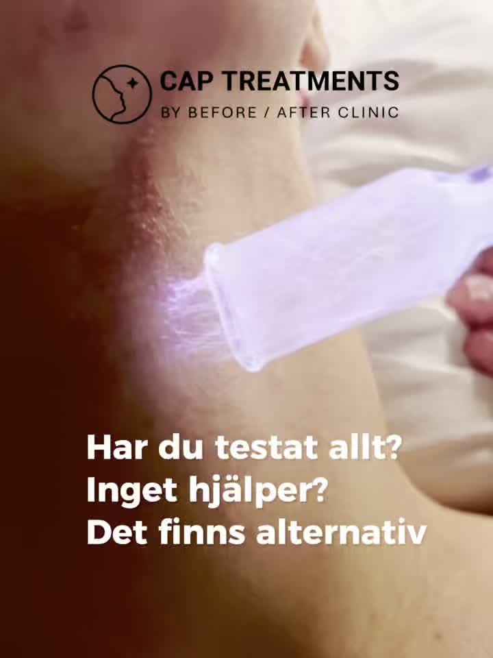 Du har provat allt. Ändå vaknar du varje natt av klåda och sveda.
Många som lider av röd, irriterad och känslig hud upplever att vanliga behandlingar inte ger den lindring de hoppas på.
Hos CAP Treatments erbjuder vi behandling med Cold Atmospheric Plasma, en modern metod som används för att lugna huden och stödja hudens återhämtning.
Behandlingen utförs på vår klinik i Malmö och Kista.