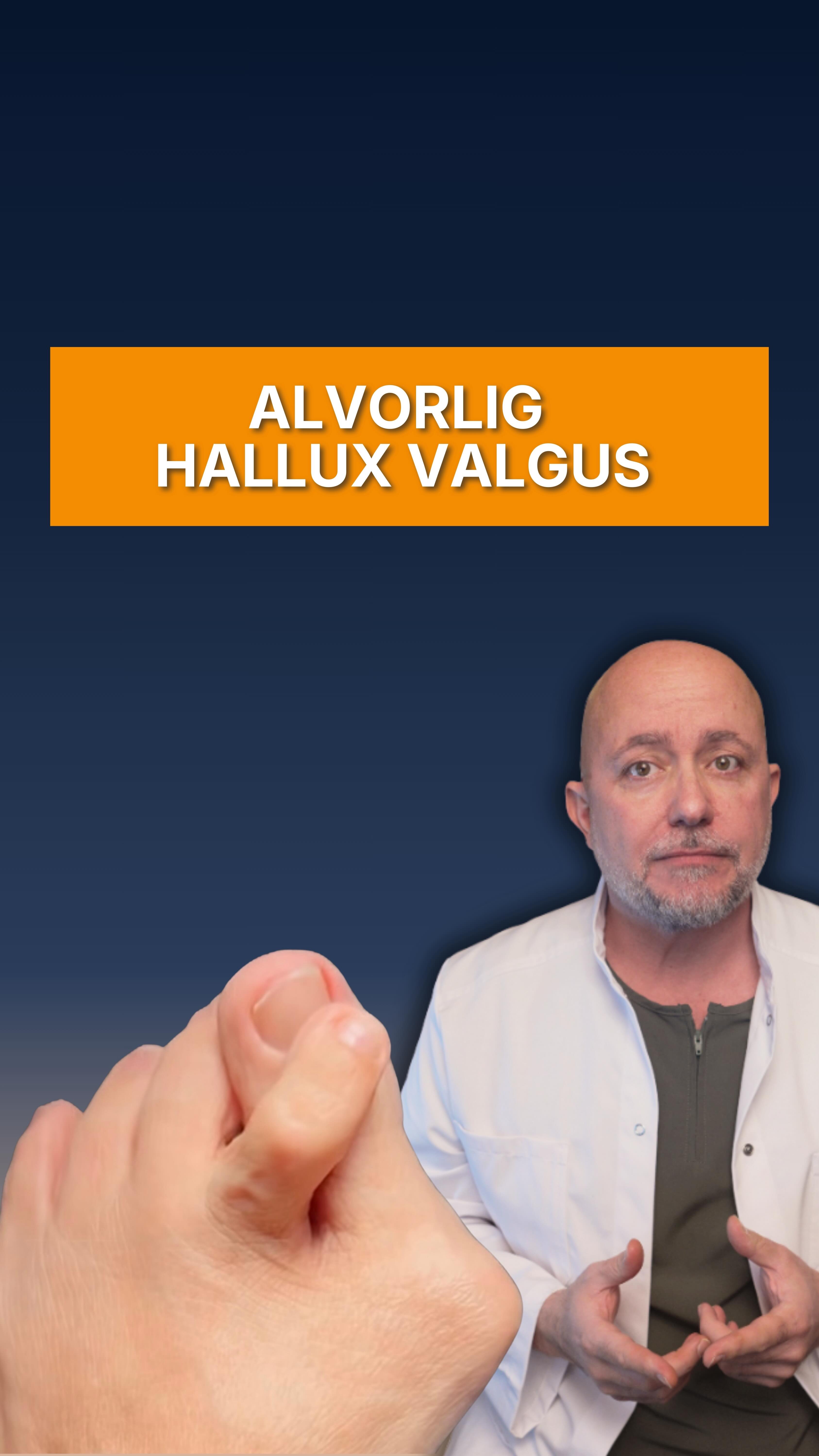 Et eksempel på hva som kan skje med foten hvis man venter for lenge med å gjøre noe med Hallux Valgus.
#halluxvalgus
#fotkirurgi
#fothelse
#kikkhullskirurgi