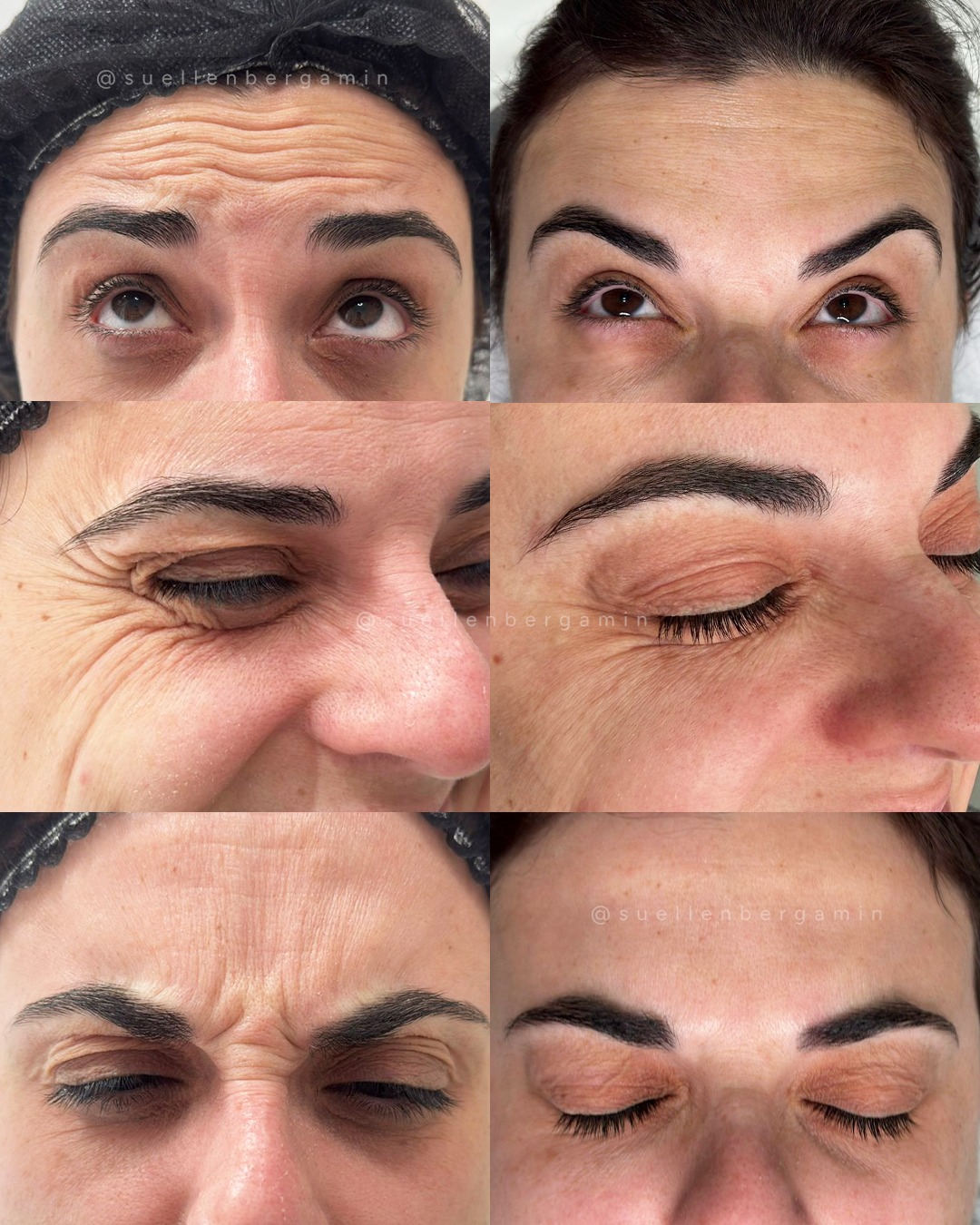 Ela não queria mudar quem é...
Queria só suavizar o que o tempo começou a marcar.
O Botox trouxe leveza para a expressão, suavizou as linhas…
mas o que mais transformou foi o jeito que ela se olha agora. ✨
Mais linda!
Mais confiante!
Mais ela mesma!
Eu amo ver esses resultados e a felicidade de quem me escolhe... ❤️
Agende seu horário e sinta essa experiência também: 📲+44 7398 192413
.
She didn’t want to change who she is…
She just wanted to soften what time had begun to mark.
Botox brought lightness to her expression and softened the lines…
but what truly transformed was the way she looks at herself now. ✨
More beautiful!
More confident!
More herself!
I love seeing these results and the happiness of those who choose me… ❤️
Book your appointment and experience this too: 📲 +44 7398 192413