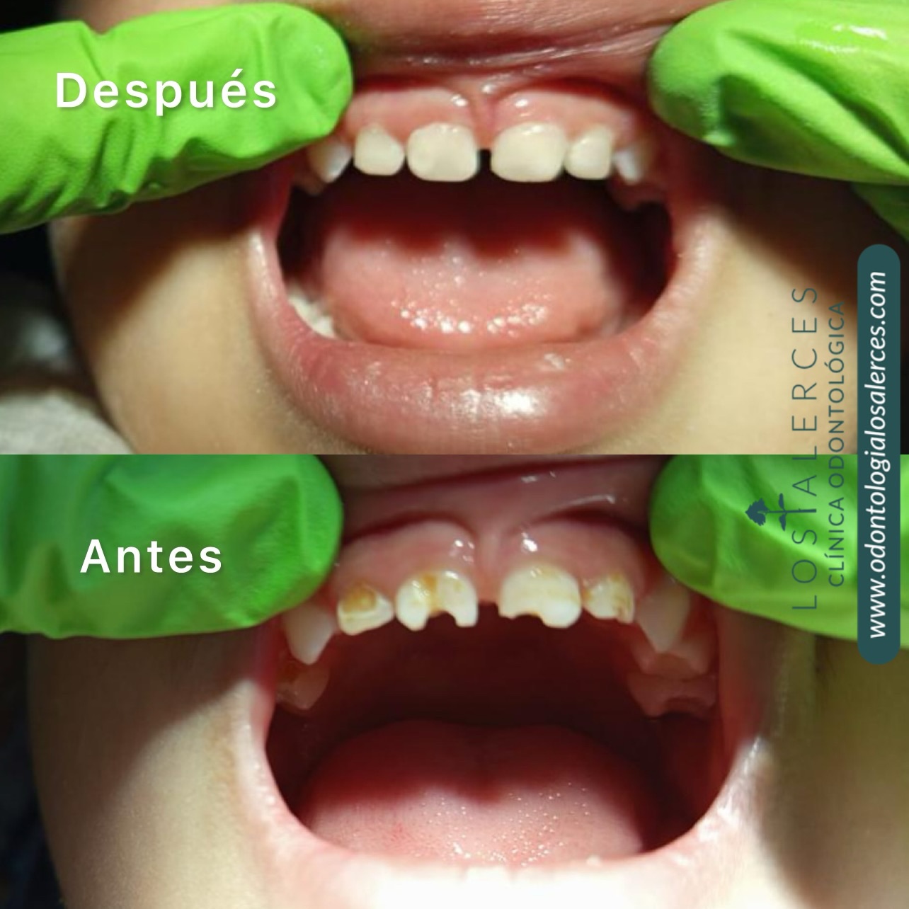 Caries Temprana de la Infancia (CTI)
Caso clínico liderado por la Dra. Paulina Burgos. Paciente 4 años, CTI, el tratamiento busca restaurar la función y, sobre todo, devolver la salud.
Agradecemos a su familia por confiar en nosotros para:
✅ Sanar las lesiones existentes.
✅ Enseñarles a prevenir futuras complicaciones.
¡No esperes a que haya dolor para visitarnos!
La prevención es nuestra mayor herramienta, te esperamos en clínica odontóloga Los Alerces.
#SaludOral #OdontologíaInfantil #Odontopediatra #CeroCaries