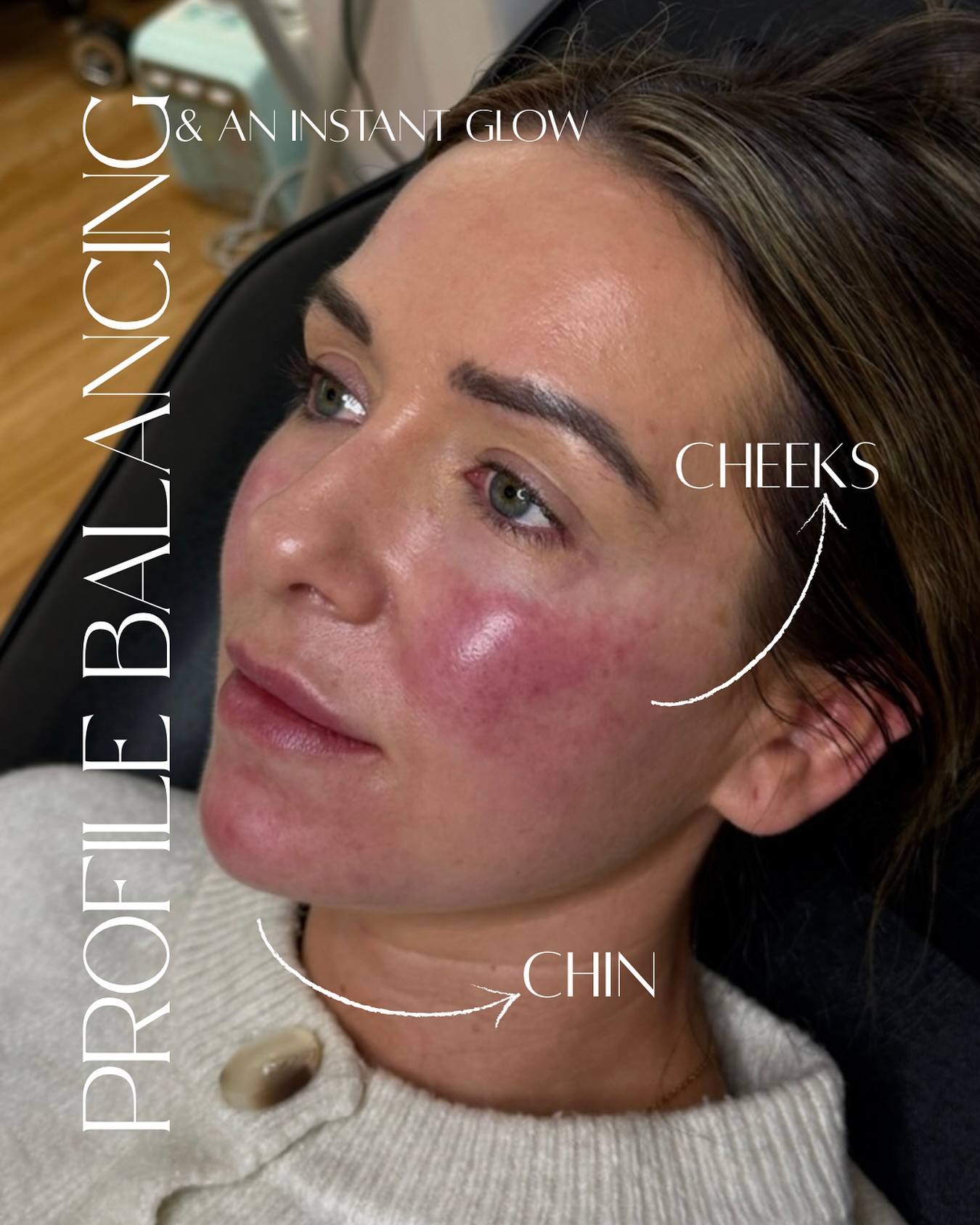Profile balancing is never one-size-fits-all.
I will always recommend a consultation to discuss what we could do to enhance your profile - no two faces are the same!
In this appointment we added some filler to the cheeks - PS how stunning is that glow✨
& a little chin filler for projection💉
Balanced. Refined. Natural
💌DM to discuss your profile balancing appointment today!
#profilebalancing #aesthetics #aestheticpractitioner #aestheticclinic #sunderland #sunderlandaesthetics #chinfiller #cheekfiller