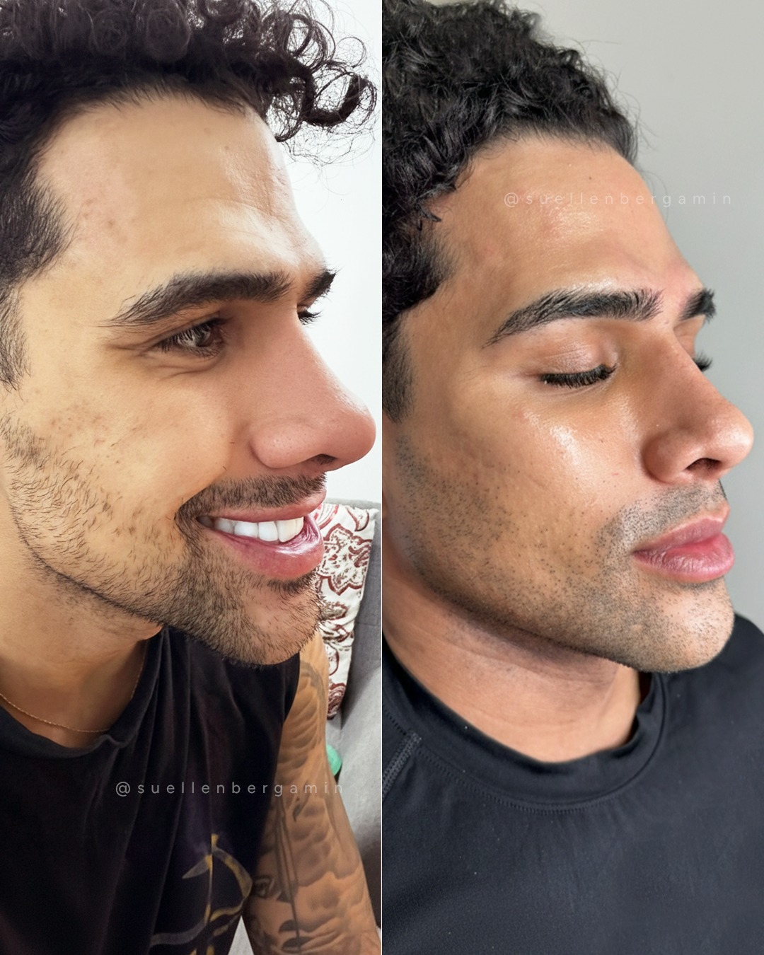 Harmonização masculina não é mudar o rosto...
É sobre estruturar, definir e devolver firmeza ao que o tempo suavizou.
Olhar menos cansado.
Maxilar mais marcado.
Expressão mais segura.
E mais autoestima em primeiro lugar. ✨
Agende seu horário: 📲+44 7398 192413
.
Male facial harmonization isn’t about changing your face…
It’s about structuring, defining, and restoring firmness to what time has softened.
A less tired look.
A more defined jawline.
A more confident expression.
And self-esteem coming first. ✨
Book your appointment: 📲 +44 7398 192413