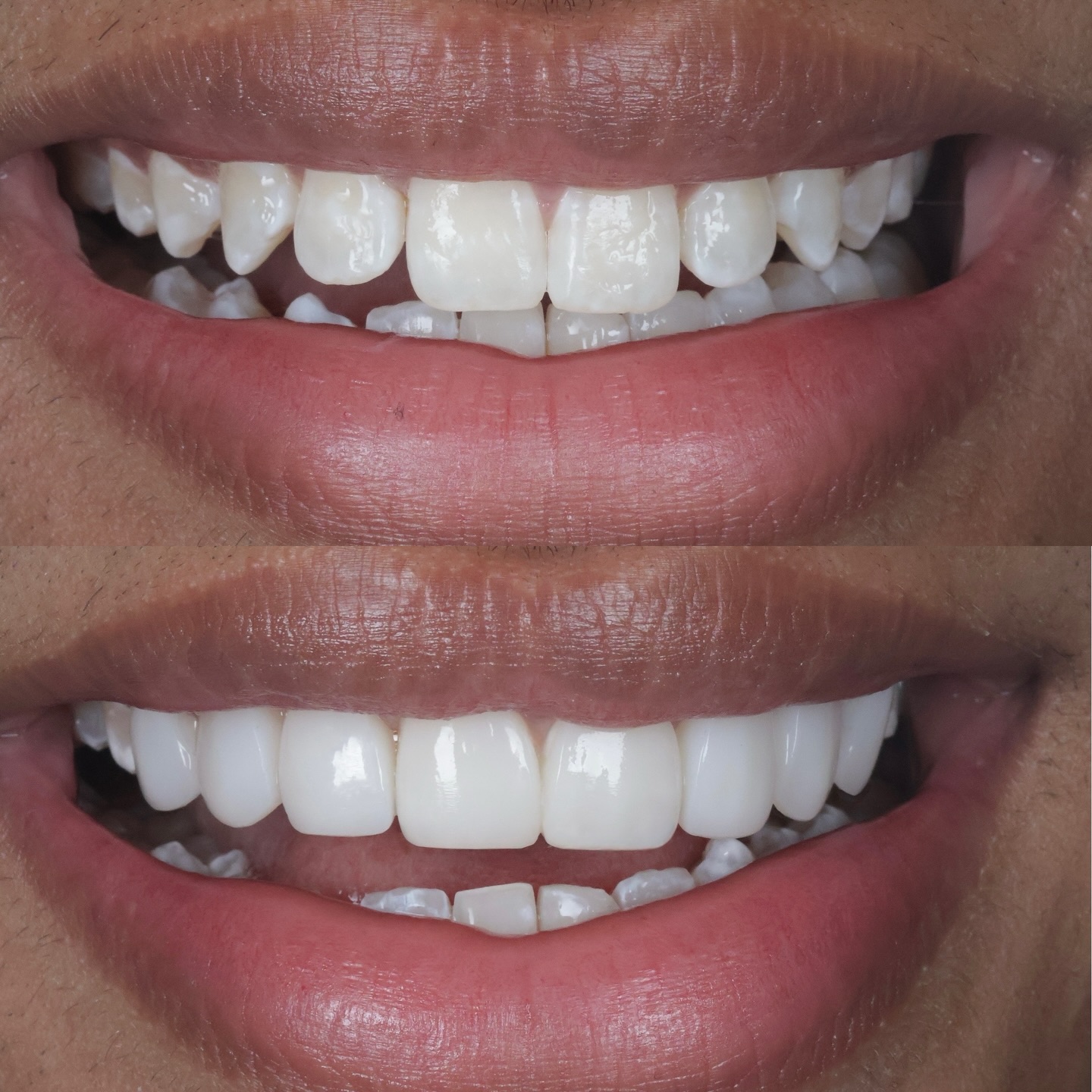 8 composite veneers to mask white spots and improve the colour, shape and inclination of the teeth
All completed without any drilling of the natural teeth
White, but natural 🦷
📩 DM to enquire about your smile transformation.
#compositebonding #compositebondinguk