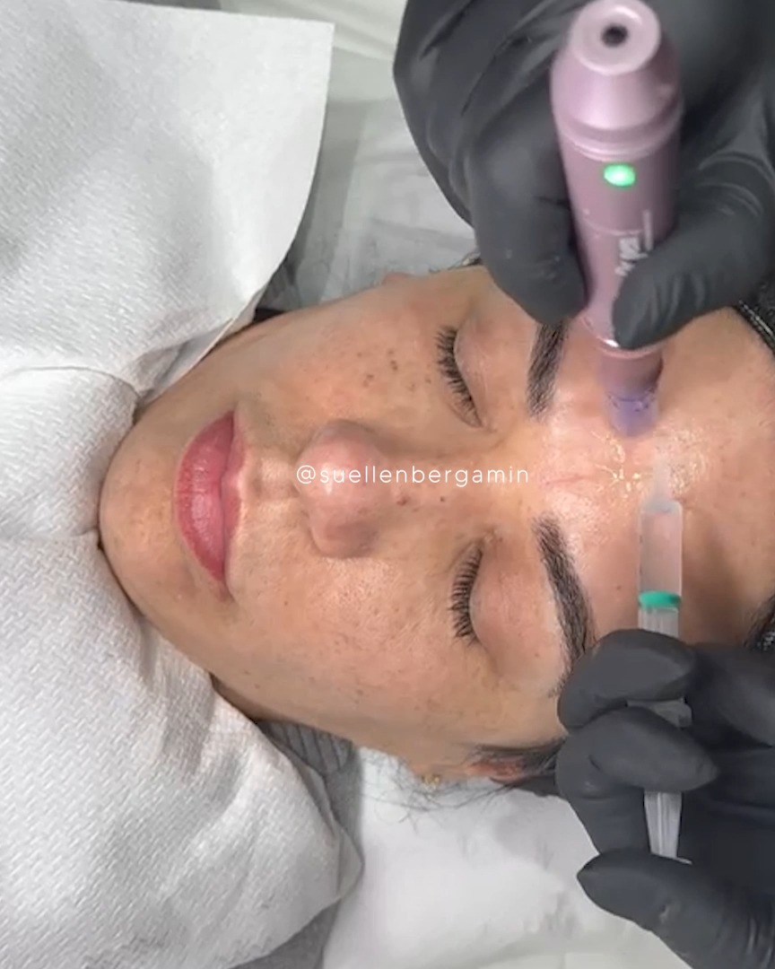 O tempo passa… mas a sua pele não precisa carregar todos os sinais dele. ✨
O Microagulhamento com PDRN é aquele tratamento que vai além da superfície.
O microagulhamento cria microcanais na pele, estimulando a produção natural de colágeno.
Já o PDRN (Polidesoxirribonucleotídeo) potencializa esse processo, acelerando a regeneração celular, melhorando a textura, firmeza e luminosidade.
💎 Ideal para:
• Linhas finas
• Flacidez
• Marcas de acne
• Poros dilatados
• Pele opaca e sem viço
O resultado?
Uma pele mais uniforme, revitalizada e com aquele glow saudável que a gente ama, sem perder a naturalidade. 🥰
Agende seu horário: 📲+44 7398 192413
.
Time passes… but your skin doesn’t have to carry all its signs. ✨
Microneedling with PDRN is a treatment that goes beyond the surface.
Microneedling creates microchannels in the skin, stimulating natural collagen production.
PDRN (Polydeoxyribonucleotide) enhances this process, accelerating cell regeneration and improving texture, firmness, and radiance.
💎 Ideal for:
• Fine lines
• Sagging skin
• Acne scars
• Enlarged pores
• Dull, tired-looking skin
The result?
More even, revitalized skin with that healthy glow we all love — without losing its natural beauty. 🥰
Book your appointment: 📲 +44 7398 192413