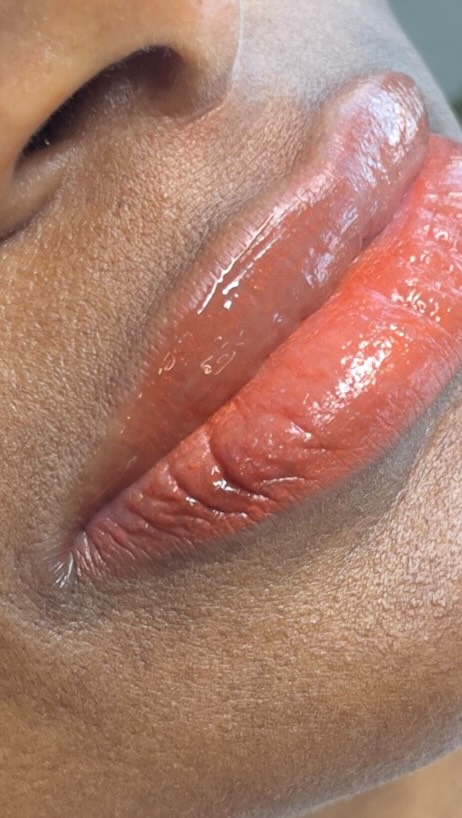 The Step-by-Step Lip Neutralization Process:
Consultation & Assessment: We will evaluate the lip’s undertones (blue, purple, or brown) to select the correct neutralizing, warm-based pigment.
Session 1 - Neutralization: We then deposit warm pigment (orange/peach) to counteract the dark, cool tones.
Immediately after, the lips may appear bright orange or red.
Healing Phase (6-10 Weeks): Lips will peel and the color will fade by 30-60%. The lips may appear darker, brownish, or even patchy during the first 2-3 weeks before brightening.
Subsequent Sessions: A second, and sometimes third, session is necessary (usually 8-10 weeks later) to further lighten, even out, and refine the color.
Expected Outcomes:
Patience is Key: The process is slow. Darker lips require more sessions (2-5) to reach a light, neutral base.
Natural Result: The aim is a healthier, more vibrant natural look, not necessarily a bright lipstick effect.
Touch-ups: While the procedure is permanent, touch-ups are recommended to maintain brightness.
BEATANDBLADE.COM
#lipneutralization #cosmetics #pmu #makeup #beauty