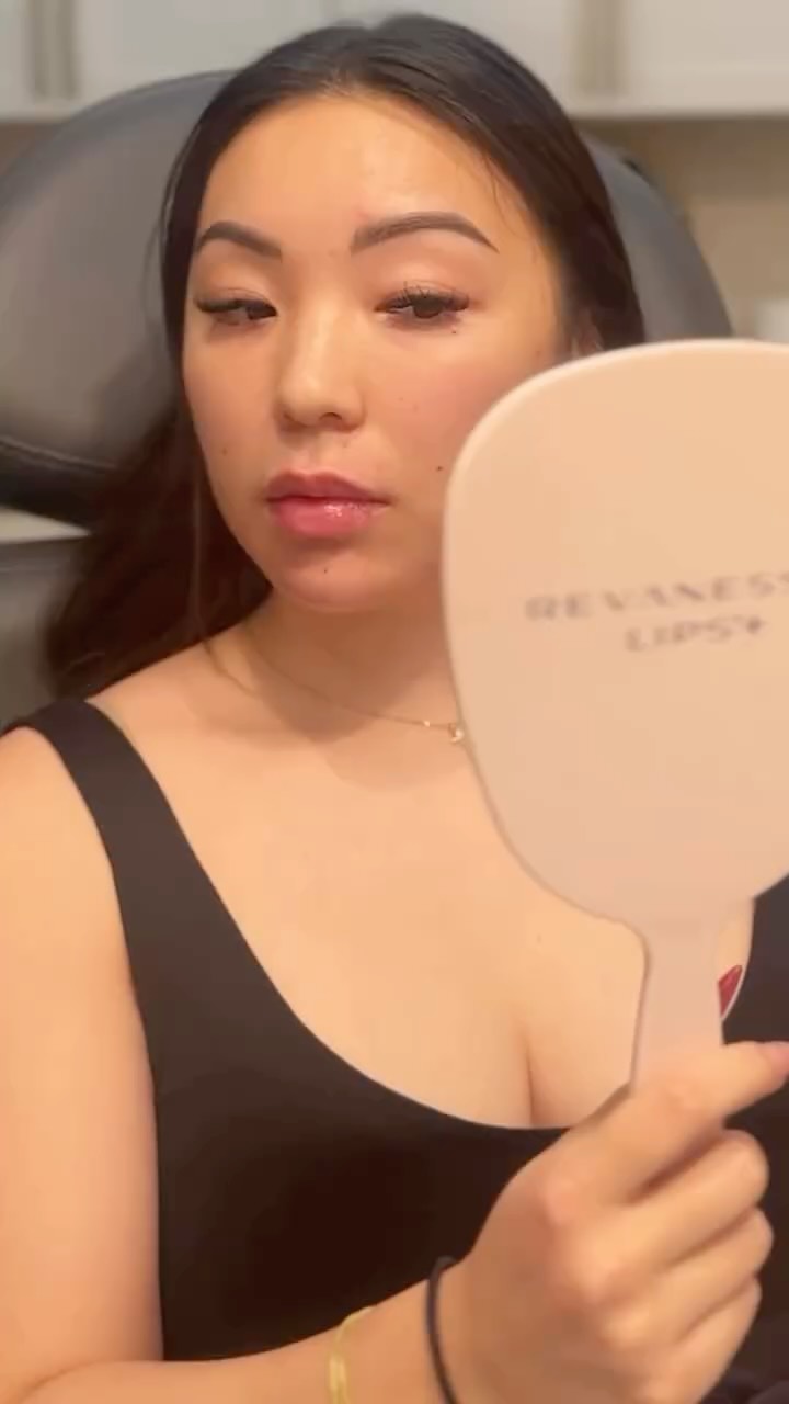 Stunning to begin with but that lower face transformation 😍
Lips ✔️
Chin ✔️
Chin Shadowing ✔️