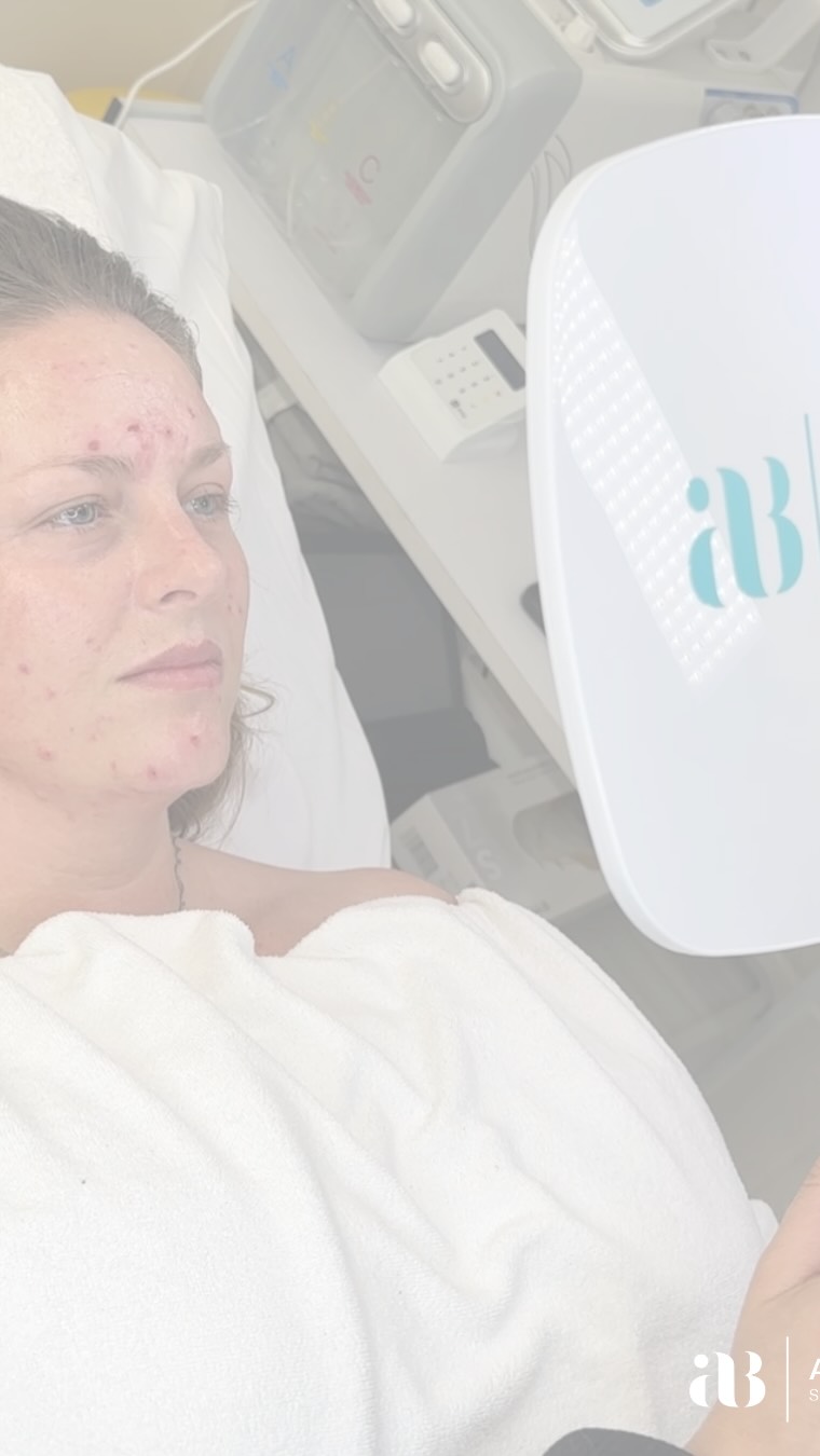 Healthy skin takes commitment. 🤍
One of my favourite parts of my job is working closely with clients through their skin packages and seeing the transformation that happens when they truly commit to the process.
Great skin doesn’t happen overnight — it takes consistency, patience and trust in the plan we create together.
This journey isn’t just about the in-clinic treatments you see on my page. While my treatments help calm inflammation, reduce breakouts and support the skin barrier, what happens outside of the clinic is just as important.
Your results are influenced by so many factors, including:
• Your daily at-home skincare routine
• Diet and nutrition
• Skin supplements
• Lifestyle habits
• Stress levels
• Hormonal balance
When you start a skin journey with me, we work on more than just treatments. I create a personalised plan that may include customised skincare, lifestyle guidance and prescribed skin supplements to support your skin from the inside out.
My treatments can calm and reduce acne, but your commitment at home helps us get to — and treat — the root cause.
When clients stay committed and consistent, that’s when the real results happen… and seeing that transformation is the most rewarding part of what I do. ❤️
—————————————————————————-
📣VERY SOON I will be looking for 3 models to undergo a full treatment plan with myself. I am specifically looking for clients with problematic skin/a damaged skin barrier.
If this is you please DM me asap with some photos of your skin 💕