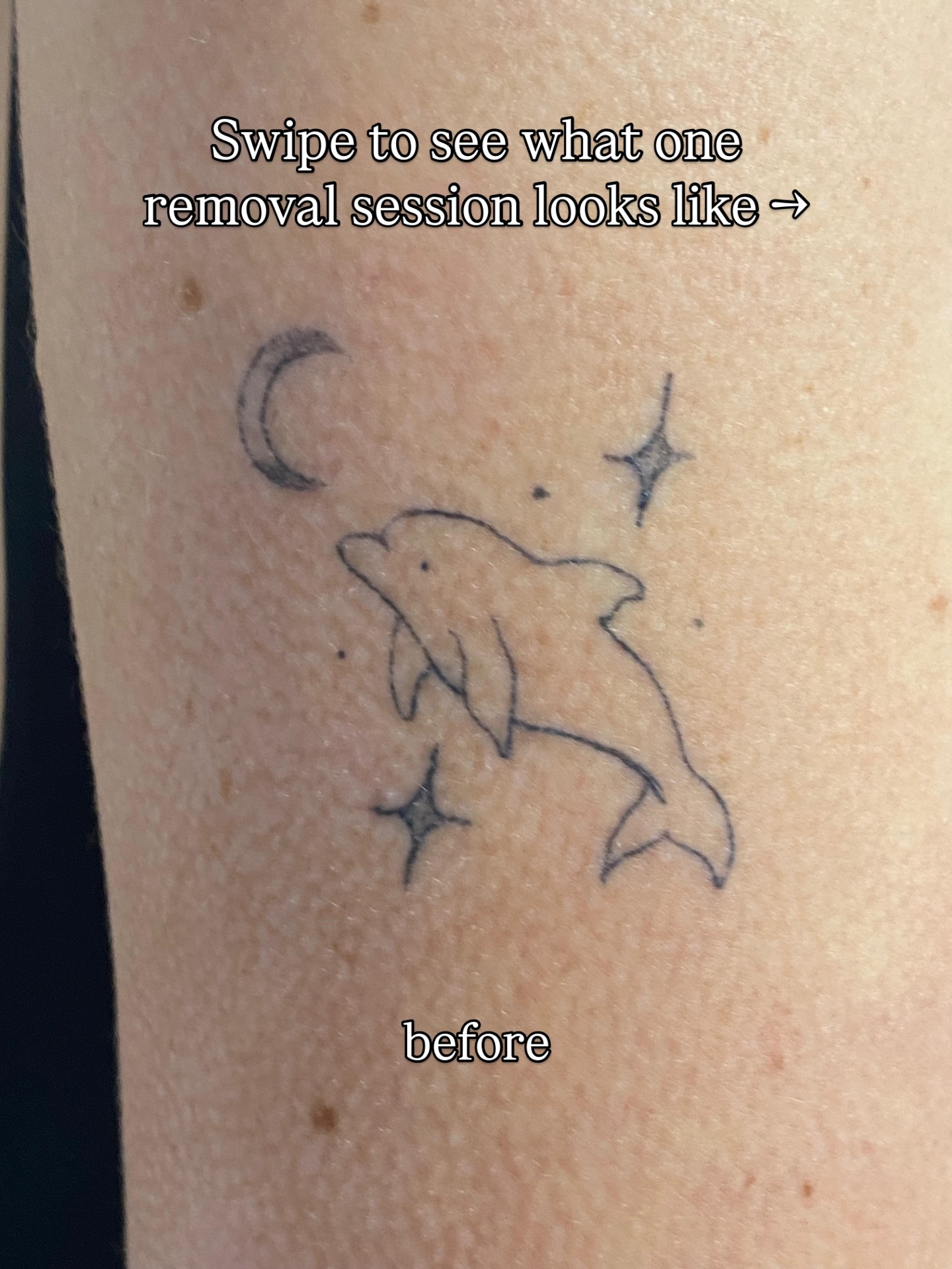 This is what one removal session normally look like 🔥
Looking to get a tattoo removal in Glasgow? Look no further!
We offer free consultations before you start your removal journey - we’ll answer all of your worries so you feel completely comfortable!
Call or text 07542902219 for all bookings.
📍Glasgow, Merchant City
#tattooscotland #lasertattooremoval #tattooremoval