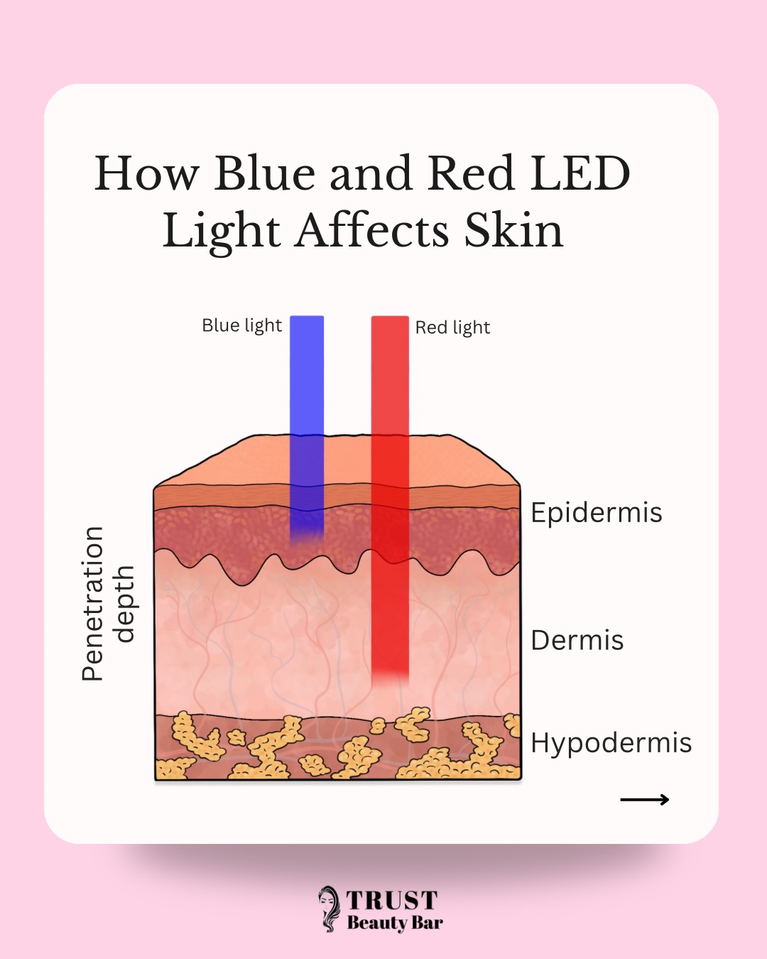 𝗟𝗘𝗗 𝗟𝗶𝗴𝗵𝘁 𝗧𝗵𝗲𝗿𝗮𝗽𝘆 — 𝗡𝗼𝘁 𝗝𝘂𝘀𝘁 𝗔 𝗧𝗿𝗲𝗻𝗱… 𝗜𝘁’𝘀 𝗖𝗲𝗹𝗹𝘂𝗹𝗮𝗿 𝗦𝗰𝗶𝗲𝗻𝗰𝗲 ✨🔬
At 𝗧𝗿𝘂𝘀𝘁 𝗕𝗲𝗮𝘂𝘁𝘆 𝗕𝗮𝗿, LED isn’t just a relaxing add-on — it’s a medical-grade therapy that works beneath the surface to repair, heal, and rejuvenate skin at a 𝗰𝗲𝗹𝗹𝘂𝗹𝗮𝗿 𝗹𝗲𝘃𝗲𝗹.
💡 𝗗𝗶𝗳𝗳𝗲𝗿𝗲𝗻𝘁 𝗟𝗶𝗴𝗵𝘁𝘀 = 𝗗𝗶𝗳𝗳𝗲𝗿𝗲𝗻𝘁 𝗥𝗲𝘀𝘂𝗹𝘁𝘀
🔴 𝗥𝗲𝗱 𝗟𝗘𝗗
• Stimulates collagen + elastin
• Speeds healing + tissue repair
• Reduces inflammation
• Supports anti-aging
🔵 𝗕𝗹𝘂𝗲 𝗟𝗘𝗗
• Targets acne-causing bacteria
• Helps regulate oil production
• Calms active breakouts
🟡 𝗬𝗲𝗹𝗹𝗼𝘄 𝗟𝗘𝗗
• Improves circulation + lymphatic flow
• Reduces redness + sensitivity
• Supports post-treatment recovery
🔥 𝗜𝗻𝗳𝗿𝗮𝗿𝗲𝗱 𝗟𝗶𝗴𝗵𝘁 (𝗗𝗲𝗲𝗽𝗲𝘀𝘁 𝗣𝗲𝗻𝗲𝘁𝗿𝗮𝘁𝗶𝗼𝗻)
• Reaches deep dermal layers
• Supports wound healing + tissue regeneration
• Reduces inflammation + pain
• Enhances cellular energy production
✨ 𝗪𝗵𝘆 𝗼𝘂𝗿 𝗟𝗘𝗗 𝗶𝘀 𝗱𝗶𝗳𝗳𝗲𝗿𝗲𝗻𝘁:
At Trust Beauty Bar we offer 𝗙𝗨𝗟𝗟-𝗕𝗢𝗗𝗬 𝗥𝗲𝗱 + 𝗜𝗻𝗳𝗿𝗮𝗿𝗲𝗱 𝗟𝗘𝗗 therapy using:
✔ 𝗦𝗼𝗹𝗶 𝗟𝗶𝘁𝗲 Medical LED System
✔ 𝗕𝗹𝗼𝗰𝗸 𝗕𝗹𝘂𝗲 𝗟𝗶𝗴𝗵𝘁 Professional Panels
These deliver 𝗺𝘂𝗰𝗵 𝗵𝗶𝗴𝗵𝗲𝗿 𝗹𝗶𝗴𝗵𝘁 𝗲𝗻𝗲𝗿𝗴𝘆 than at-home devices — meaning deeper penetration, faster healing, and real cellular results.
✨ 𝗣𝗲𝗿𝗳𝗲𝗰𝘁 𝗳𝗼𝗿:
• Skin rejuvenation + anti-aging
• Acne + inflammation
• Post-procedure healing
• Lymphatic support
• Full-body wellness + recovery
Because true skin health starts from within — not just on the surface.
📍 Vaughan, ON
📲 Book via link in bio
#TrustBeautyBar #LEDTherapy #RedLightTherapy #InfraredLight #SkinHealing MedicalSpaCanada FullBodyLED SkinRejuvenation