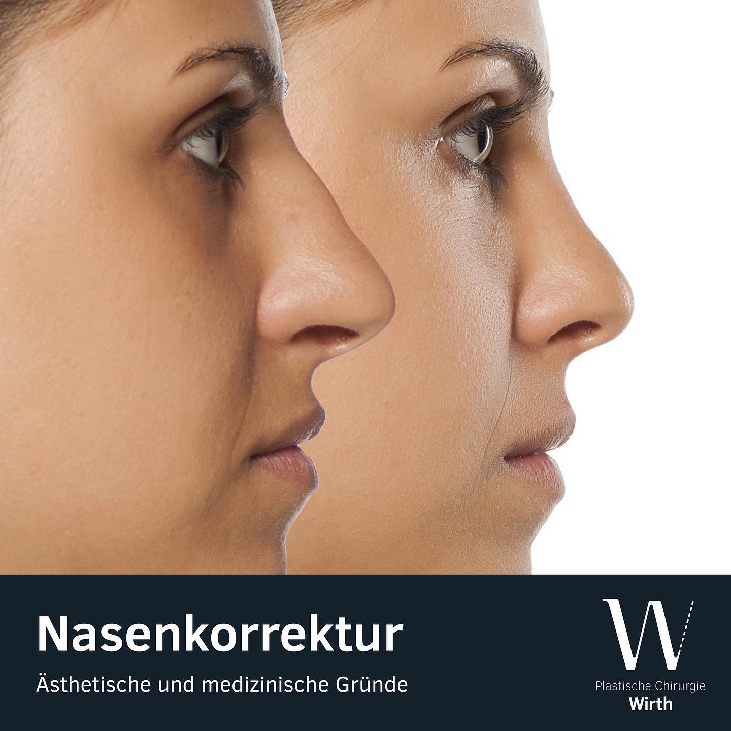 Die Nase ist der Mittelpunkt des Gesichtes, und wohl kaum eine Gesichtspartie kann als so störend empfunden werden. Die Betroffenen fühlen sich durch den Makel unattraktiv und leiden mitunter lebenslang unter den psychischen Folgen.⠀
Hier kann die Plastische Chirurgie mit ihren sowohl ästhetischen als auch funktionellen Korrekturmethoden Abhilfe schaffen, denn Nasenkorrekturen werden nicht nur aus ästhetischen Gründen durchgeführt. Oft besteht zusätzlich zum ästhetischen Makel auch ein medizinisches Problem (z.B. eine Behinderung der Nasenatmung infolge einer Krümmung der Nasenscheidewand). Dieses kann in der gleichen Operation behoben werden.⠀
Die Narben verlaufen bei einer Nasenkorrektur im Naseninnern und am Nasensteg. Dabei wird, je nach gewünschter Veränderung, der Nasenhöcker abgetragen, die Nase verschmälert, begradigt und die Nasenspitze angehoben und verfeinert.⠀
⠀
⠀
Correction du nez (rhinoplastie, rhinoseptoplastie)⠀
Le nez étant le centre du visage, il represente une des parties faciales souvent perçue comme la plus dérangeante. Beaucoup de personnes qui n’aiment pas leur nez ne se sentent pas attractives et peuvent même souffrir de troubles psychiques pendant toute leur vie.⠀
Ici, la chirurgie plastique et ses techniques de correction, esthétique ou fonctionnelle, peut éventuellement porter remède à une telle situation de mal-être. En fin de compte, l’on ne recourt pas à une correction nasale uniquement pour des raisons d’esthétique. Le défaut visible est souvent accompagné d’un problème médical (p. ex. une respiration entravée par une cloison nasale déviée). Une telle déformation peut être corrigée dans la même intervention chirurgicale.⠀
⠀
En cas de correction nasale, les cicatrices restent à l’intérieur du nez et à la base de celui-ci. Selon la correction souhaitée, les narines peuvent être diminuées, le nez affiné ou redressé, ou bien, la pointe du nez relevée et affinée.⠀
⠀
#praxiswirth #drmedraphaelwirth #plastischechirurgie