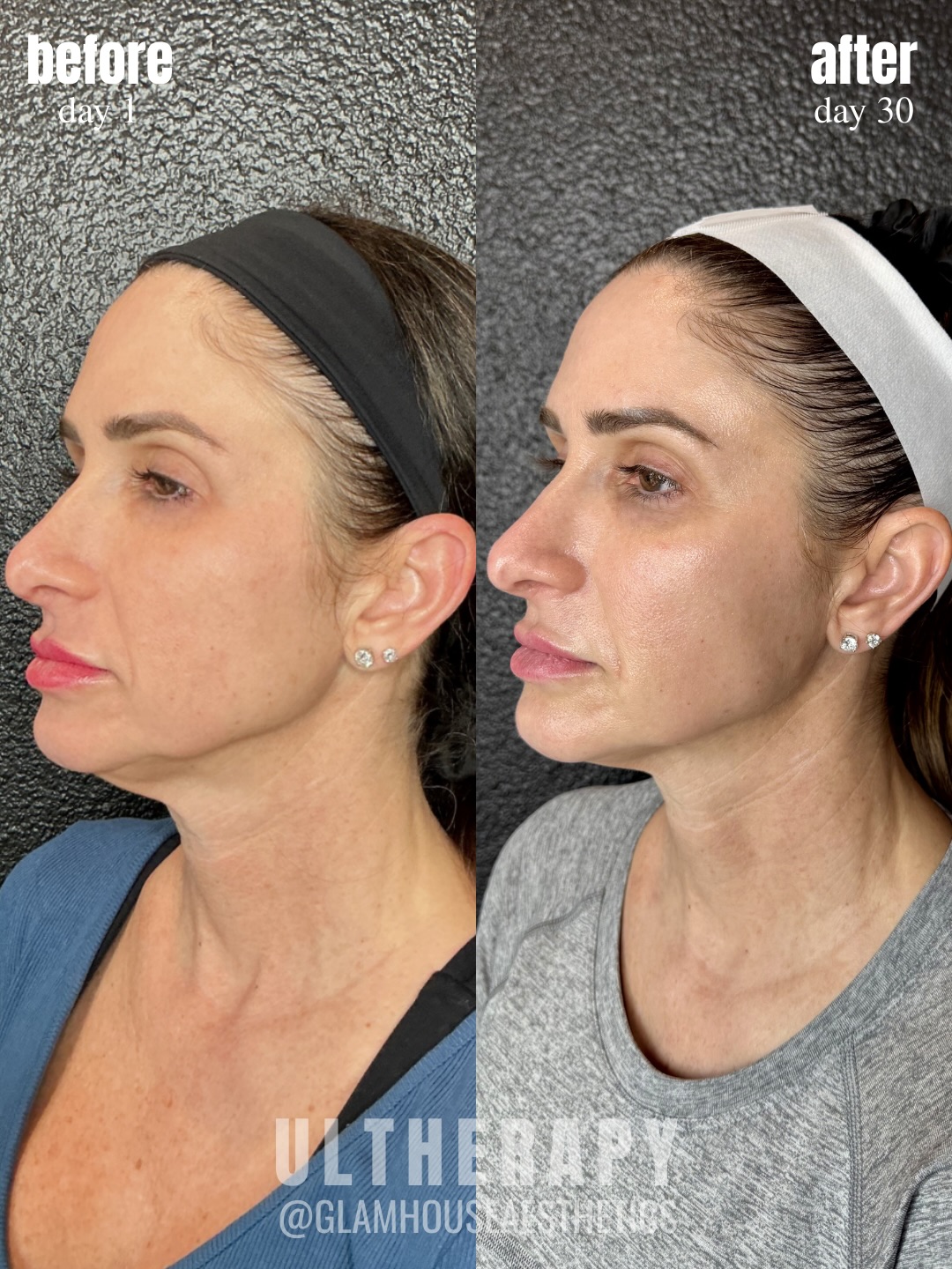 30 days after Ultherapy and the lift is already beginning to show. đ
This patient came in wanting improvement in her neckline, early jowling, and midface laxity without surgery. Just 4 weeks after treatment, you can already see increased firmness through the jawline, a smoother neckline, and subtle lifting through the midface.
Ultherapy works by stimulating your bodyâs natural collagen production deep beneath the skin, gradually tightening and lifting over time.
While these early changes are exciting, the full result is still developing & collagen remodeling continues for up to 6 months, meaning her results will continue to improve.
Non-surgical lifting, powered by your bodyâs own collagen.
Glamhouse Aesthetics & Wellness | New Braunfels | New Braunfels MedSpa | San Antonio MedSpa | Ultherapy | Facial Rejuvenation