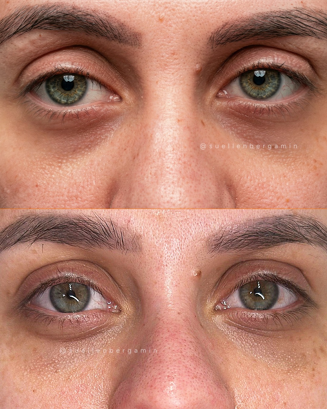 Bioestimulador na área dos olhos: firmeza + melhora da coloração das olheiras 👇
A região dos olhos pode apresentar:
• Linhas finas
• Flacidez
• Pele afinada
• Olheiras com coloração mais escura
O bioestimulador estimula a produção natural de colágeno, melhorando a qualidade da pele e ajudando também na uniformização da coloração, especialmente quando a olheira está associada à pele fina e à vascularização aparente.
Com o tratamento, é possível observar:
✔️ Mais firmeza
✔️ Pele mais espessa e saudável
✔️ Melhora na tonalidade
✔️ Aspecto menos cansado
Os resultados são progressivos e naturais, respeitando a anatomia de cada paciente.
Agende seu horário: 📲+44 7398 192413
.
Biostimulator in the under-eye area: firmness + improvement in dark circle pigmentation 👇
The eye area may present:
• Fine lines
• Sagging
• Thinner skin
• Darker under-eye pigmentation
The biostimulator stimulates the skin’s natural collagen production, improving overall skin quality and helping to even out pigmentation — especially when dark circles are related to thin skin and visible vascularization.
With the treatment, you may notice:
✔️ Increased firmness
✔️ Thicker, healthier-looking skin
✔️ Improvement in skin tone
✔️ A less tired appearance
Results are progressive and natural, respecting each patient’s anatomy.
Book your appointment: 📲 +44 7398 192413