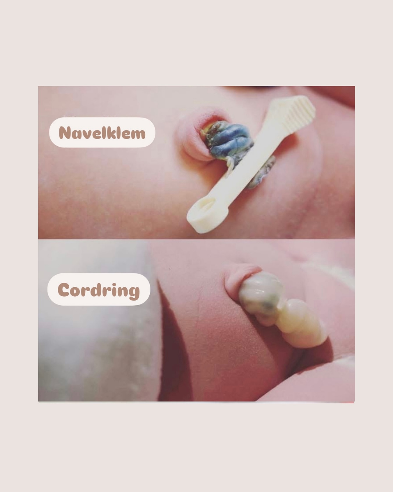 Navelklem of cordring… wat kies jij voor je baby? 🤍
Na de geboorte wordt de navelstreng doorgeknipt om je baby los te maken van de moederkoek. Geen zorgen: je baby voelt hier niets van, want de navelstreng bevat geen zenuwen.
Om nabloeden te voorkomen, wordt de navelstreng afgeklemd. Een klein stukje blijft nog even aan je baby vastzitten en valt meestal na 1 à 2 weken vanzelf af.
Tegenwoordig wordt in veel ziekenhuizen gekozen voor een cordring als modern alternatief voor de klassieke navelklem. Maar wat is nu precies het verschil?
✨ Cordring
Een klein, zacht en elastisch ringetje dat de navelstreng afsluit.
Voordelen:
• Veel kleiner en lichter
• Minder druk op het buikje
• Comfortabeler bij het verschonen
• Snellere indroging van de navelstomp
• Milieuvriendelijker
Mogelijk nadeel:
• Moeilijker te plaatsen bij een dikkere navelstreng
✨ Klassieke navelklem
Voordelen:
• Geschikt voor dikkere navelstrengen
• Wordt gebruikt wanneer je baby snel medische zorg nodig heeft (sneller te plaatsen)
Nadelen:
• Groter en harder
• Kan wat in de weg zitten bij huid-op-huidcontact
Elke situatie is anders en samen bekijken we wat het beste past bij jou en je baby 💛
Had jij hier al eens over nagedacht? Laat het gerust weten in de reacties 👇