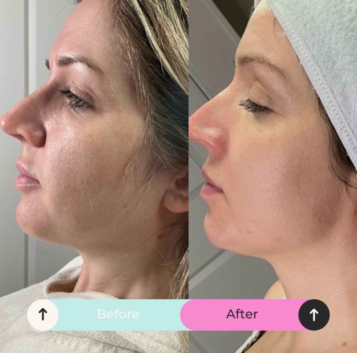 Skin glow up ✨
Summer skin is calling now the sun is finally starting to make its way out ☀️
DM for your free consultation or a bespoke package tailored to your skin 🤍