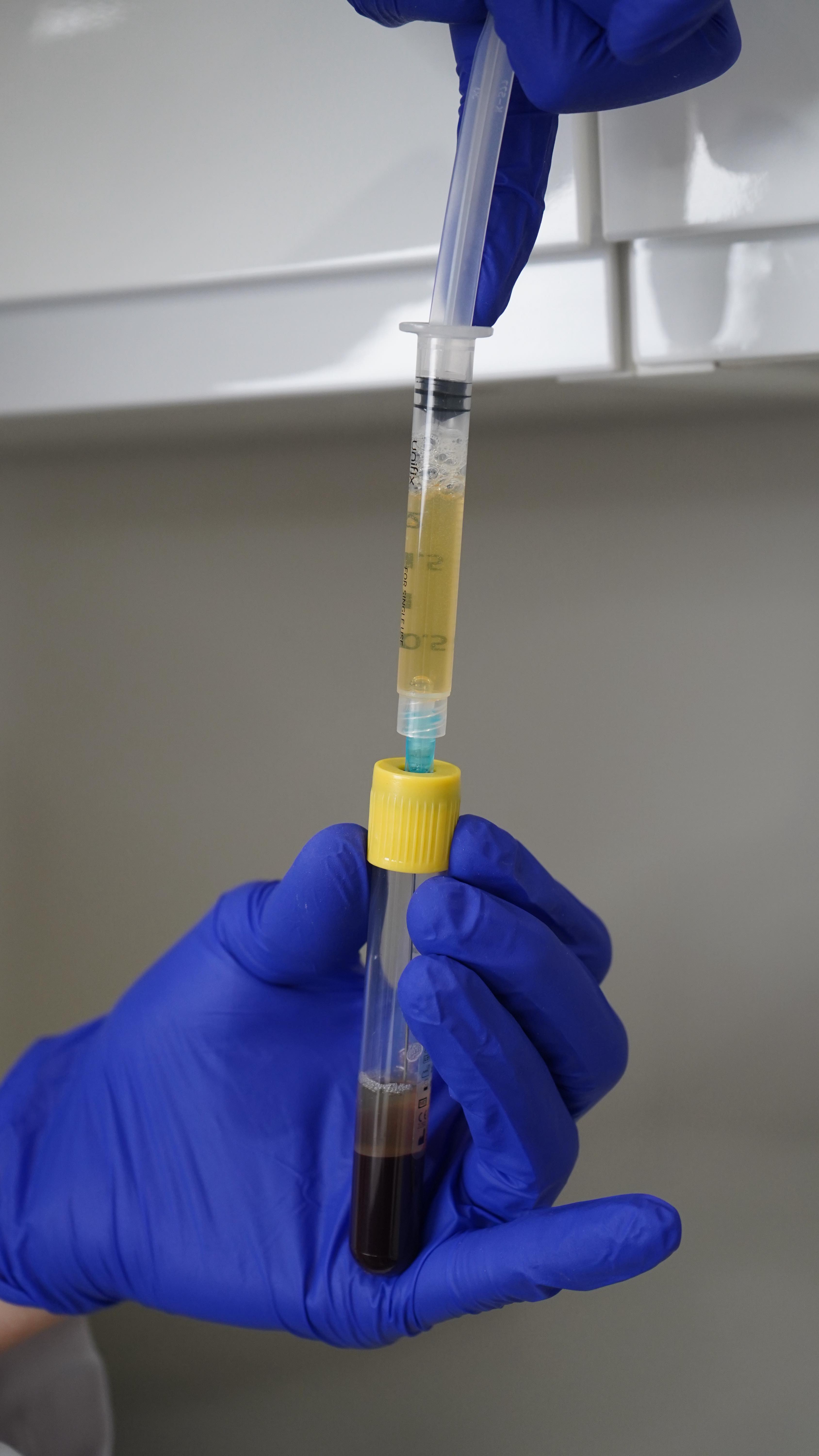 💉 What’s in a PRP injection?
PRP is your own blood centrifuged to separate platelet-rich plasma and Injected back into the skin to stimulate collagen & regeneration
✅ Why it works:
• Platelets → boost collagen & elastin
• Plasma proteins → support tissue repair
• Stem cell signals → promote skin renewal
🌿 Benefits for under-eyes:
1️⃣ Improves skin quality – firmer, smoother under-eyes
2️⃣ Reduces fine lines & wrinkles naturally
3️⃣ Brightens dark circles
4️⃣ Hydrates & rejuvenates from within
5️⃣ Natural results – no chemicals, minimal risk
6️⃣ Long-term improvement as collagen remodels
💡 Filler isn’t always the answer.
Book your consultation first via the link in bio- Limited availability 😎
@prppure
#surbiton #prp