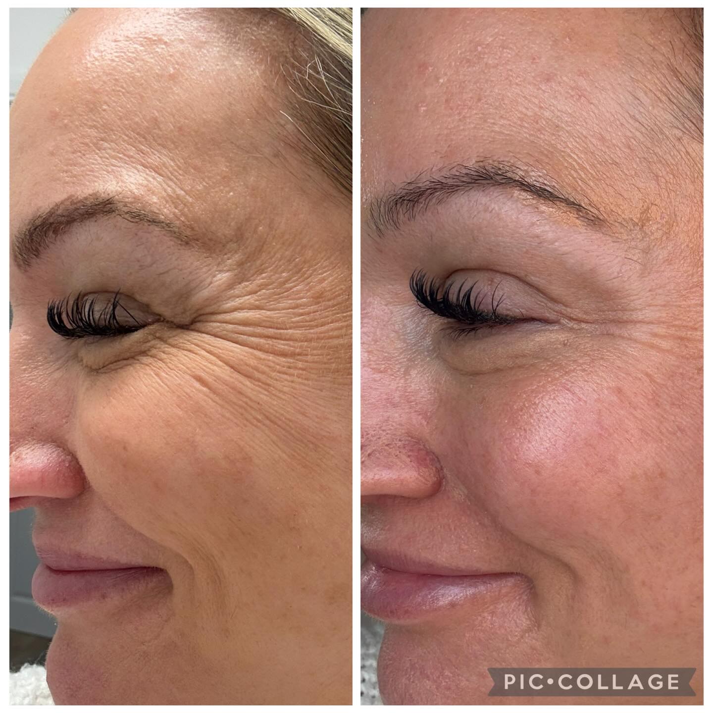 The results are in!
This is before and after of my first @medi_mduk glycolic peel that I had this morning. Over the moon with these results, especially the plumping around my mouth and the reduction of fine lines round my eyes and on my forehead.
No makeup today but straight out and about after the treatment, just an hour or so of slight redness afterwards
All our peels are half price in March. Book under special offers on booksy. Link in bio
#rubymoontherapiea #reigate #horley #redhill #skincare