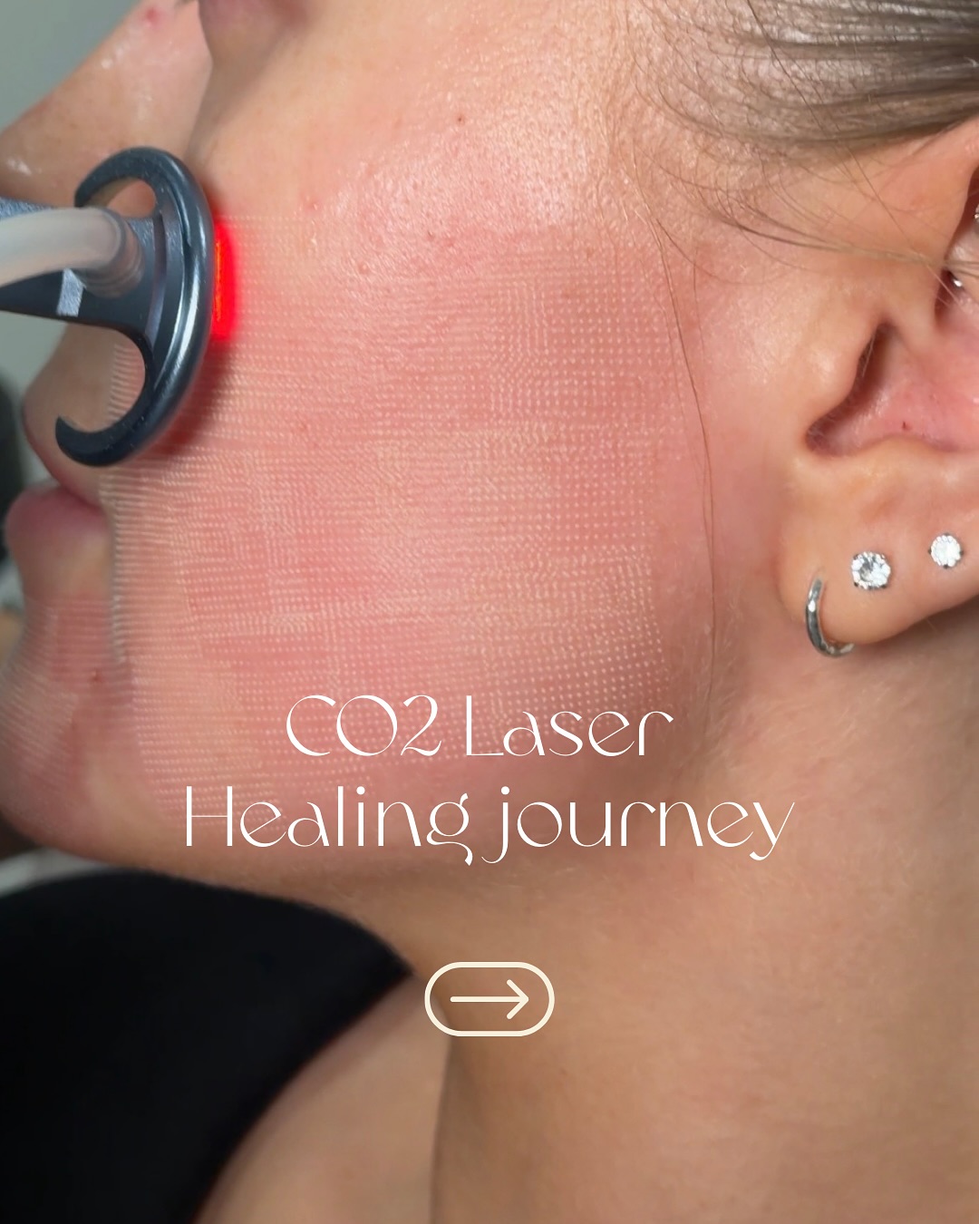 Healing is a journey ✨
Day 1 (next day): redness, warmth, and the start of the renewal process.
Day 2: skin feels tight and dry as resurfacing continues.
Day 4: peeling and shedding — out with the old, damaged layers.
Day 6: fresh, new skin revealed with improved tone and texture.
2 Weeks: brighter, smoother, more even — and we’re still not done.
After a Carbon dioxide laser resurfacing treatment, your skin continues healing beneath the surface for weeks to months. Collagen is actively rebuilding, strengthening, and tightening — meaning results will keep improving over time.
Trust the process. Real transformation happens in layers. 💫