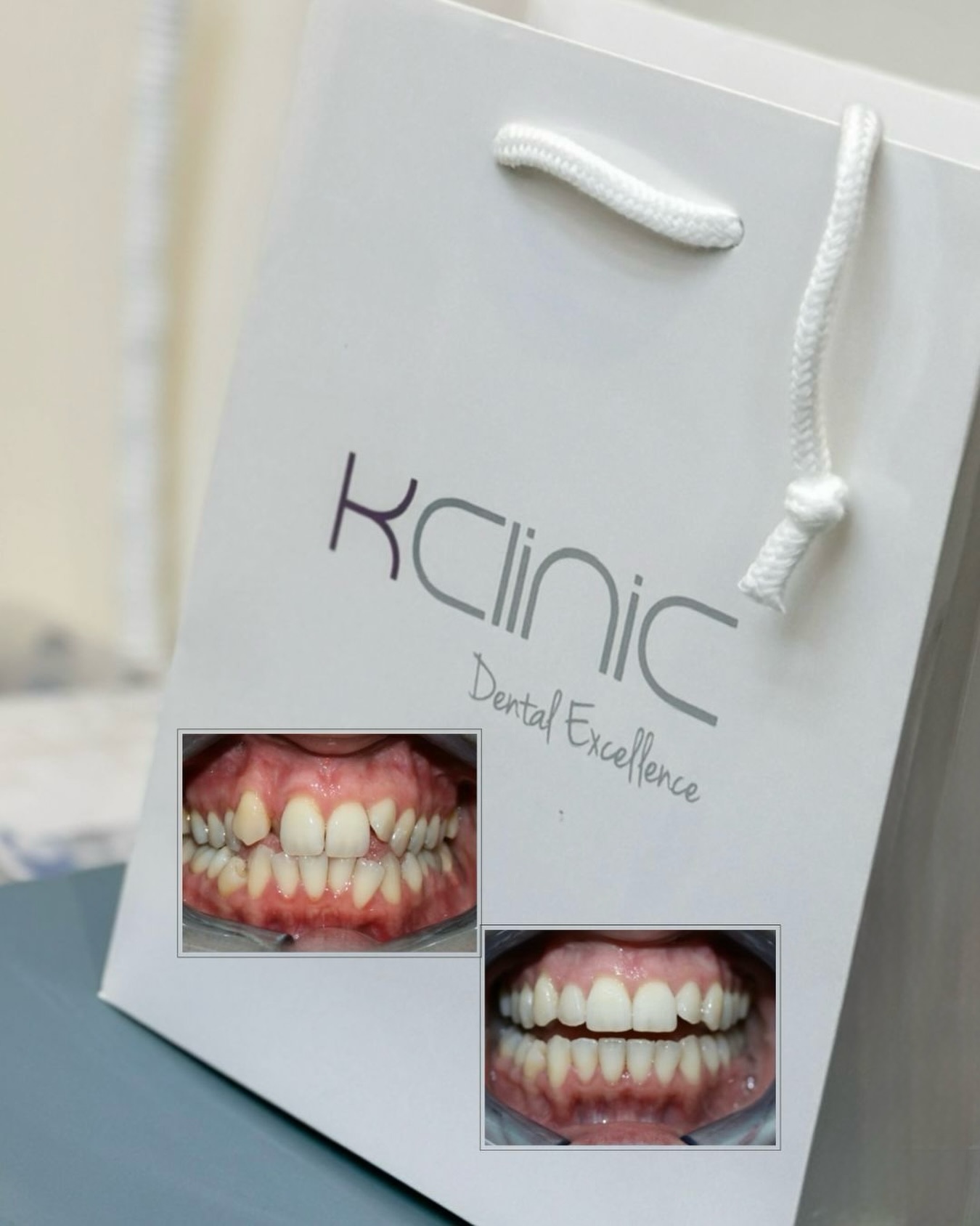 Invisalign® smile transformation ✨
Who is Invisalign® for?
For adults and teens who want to straighten their teeth in a discreet way. 🦷
It’s great for:
✔ crowded or overlapping teeth
✔ gaps or spaces
✔ overbites, underbites & crossbites
✔ crooked or misaligned teeth
What is Invisalign®?
Invisalign uses a series of custom-made, clear aligners to gently move your teeth into their ideal position.
They are almost invisible and removable — so you can eat, drink and brush your teeth as normal 🫶🏼
Clear. Comfortable. Removable.
And the results? Totally worth it 🤍
📩 Book your free consultation with @ortho_mlp and take the first step toward the smile you truly deserve.
0 % Finance options available
📍7 Windsor Way, Knutsford WA16 6JB
🌐 www.kclinic.co.uk
📱 07946 219 539
☎️ 01565 653480
#orthodontist#invisaling#smiletransformation#freeconsultation#clearaligners