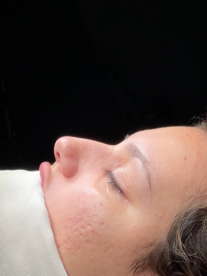 Reduction💪💪
The philtrum was not shortened⭐️
