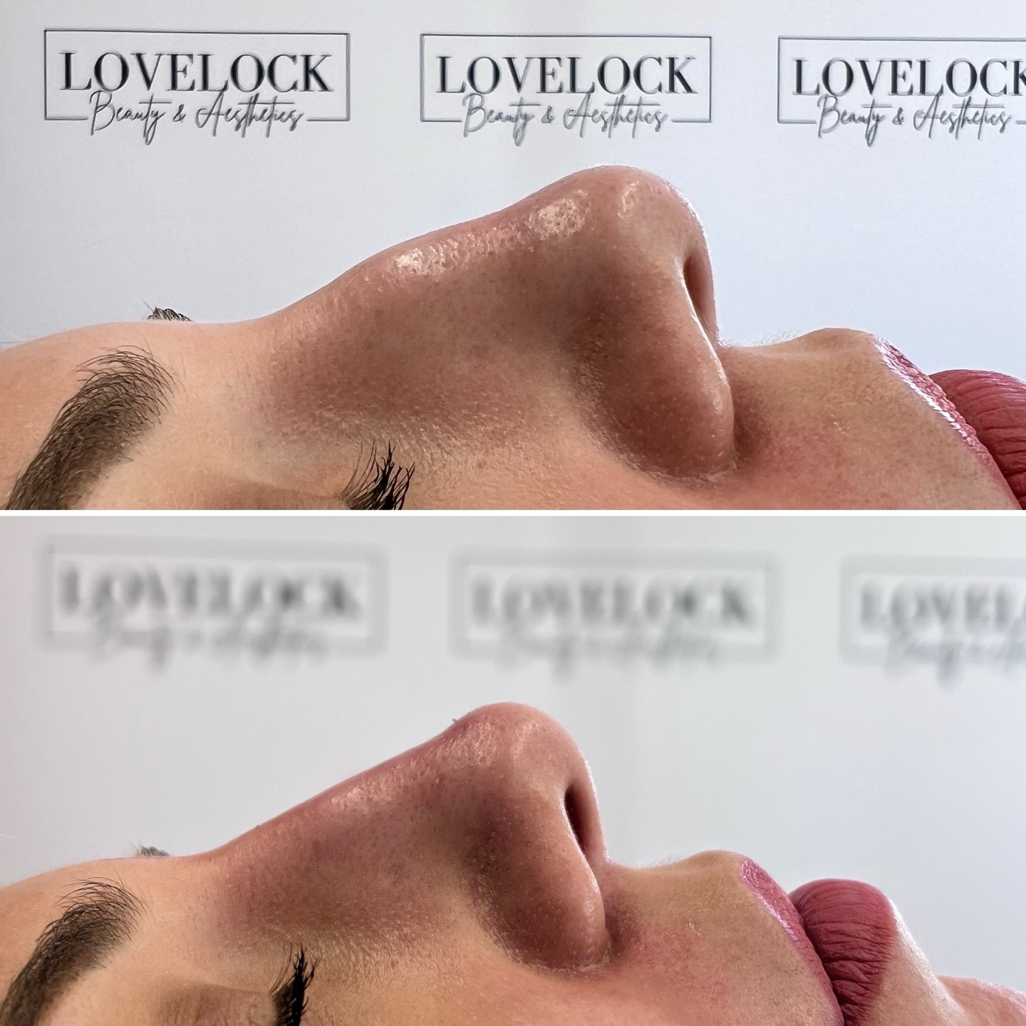 Another amazing transformation on my client!
If you don’t like the side profile of your nose, it can easily be fixed.
please feel free to get in contact.
⭐️ Award-winning level 7 aesthetic practitioner
📍 Romsey 📍 Warminster
#warminster #westbury #trowbridge #romsey #romseylife