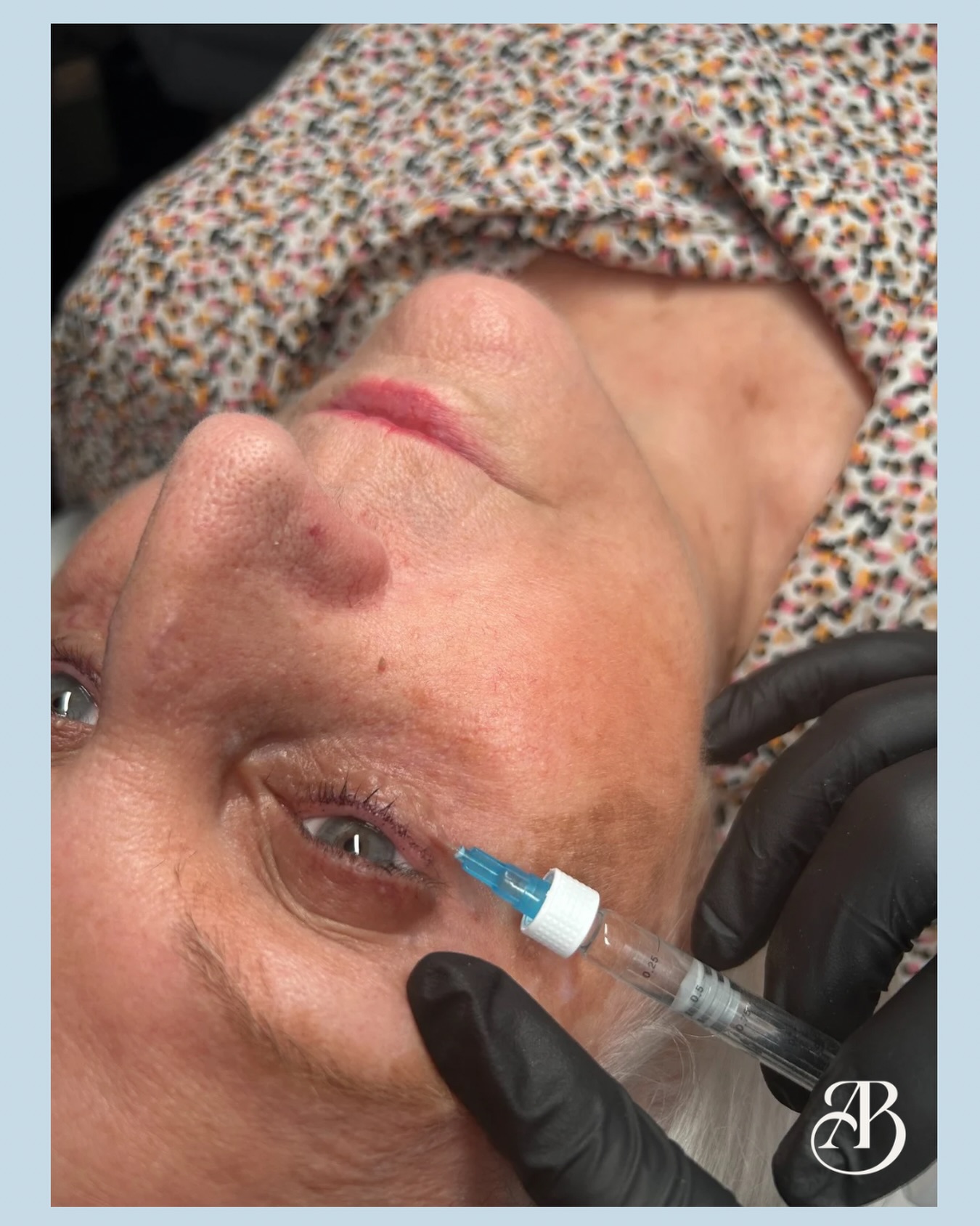 Want to regenerate your tired skin? ✨
Let’s talk Polynucleotides 💦 The next level regenerative treatment your skin will LOVE.
Polynuclotides are powerful DNA fragments that work at a cellular level to stimulate skin repair, boost collagen production, and deeply hydrate from within. Unlike traditional fillers, this treatment doesn’t just “add volume”, it improves overall skin quality, texture and elasticity over time.
💎 Benefits:
• Improves skin firmness & elasticity
• Boosts collagen + elastin production
• Deep hydration from within
• Reduces fine lines & crepey skin
• Helps repair damaged or acne-prone skin
• Gives that natural, healthy glow ✨
Perfect for under-eyes, face, neck and even acne scarring, polynucleotides are all about long-term skin regeneration and natural results.
This is your glow up, upgraded. 😍
DM us or follow the link in our bio to book your consultation today! 💌
📍Oldswinford, Stourbridge
#polynucleotides #aesthetics #nurseinjector #rejuvenate #skintreatment