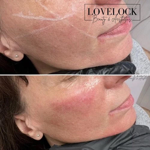 Cheek and Jawline Sculpting
🏆 NBA WINNER Best facial sculpting 2026 🏆
📕 Level 7 Expert Practitioner.
A sculpted jawline can completely transform facial balance and definition ✨
Jawline contouring with dermal filler is a non-surgical treatment designed to enhance structure, improve symmetry, and restore lost definition along the lower face.
✨ Benefits of jawline sculpting:
• Creates a sharper, more defined profile
• Enhances facial proportions and harmony
• Supports jowls and softens lower-face heaviness
• Can subtly lift the lower face
• Immediate, natural-looking results
• Minimal downtime
Perfect for anyone wanting a more contoured, youthful appearance without surgery.
Results are tailored to your unique facial anatomy for a refined, not “overdone” finish.
📍Book your consultation today to see if jawline sculpting is right for you.
#warminster #trowbridge #westbury #hilperton #frome