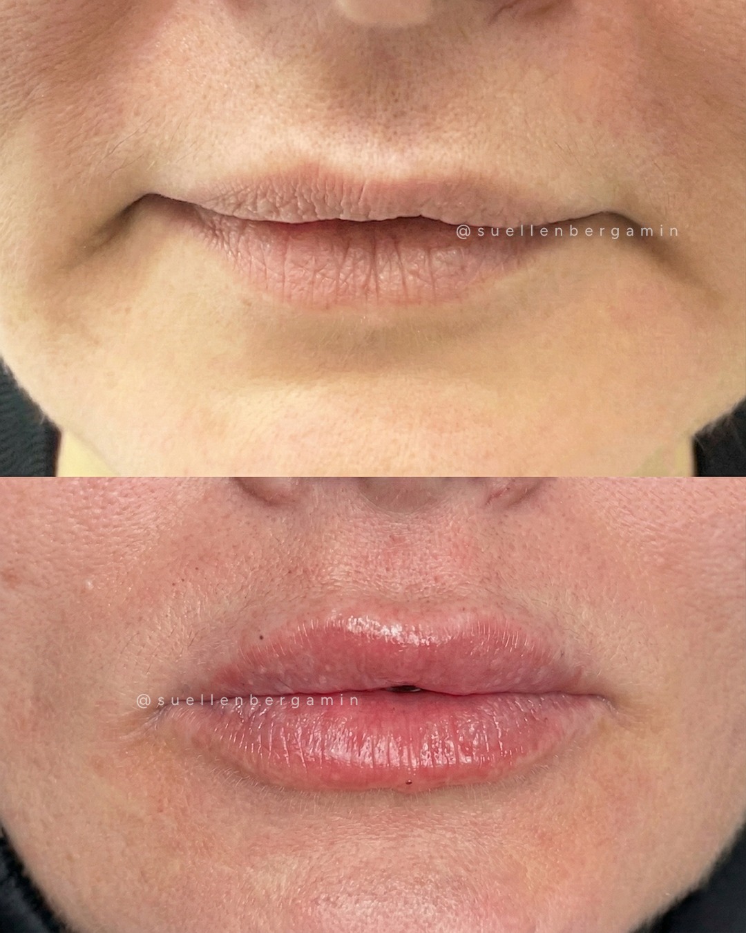 Você não quer lábios maiores.
Você quer se reconhecer no espelho… e gostar do que vê.
O preenchimento labial não é sobre exagero.
É sobre corrigir aquele detalhe que sempre te incomodou, sabe?
É quando alguém diz:
“Você está diferente… mais bonita.”
Então, se for para fazer, que seja com naturalidade, técnica e respeito ao seu formato.
💬 Me conta: Um receio que ainda te impede de fazer o seu Preenchimento Labial?
.
You don’t want bigger lips.
You want to recognize yourself in the mirror… and like what you see.
Lip filler isn’t about exaggeration.
It’s about correcting that little detail that has always bothered you, you know?
It’s when someone says:
“You look different… more beautiful.”
So if you’re going to do it, let it be with natural results, technique, and respect for your unique shape.
💬 Tell me: What’s one concern that’s still holding you back from getting your Lip Filler?