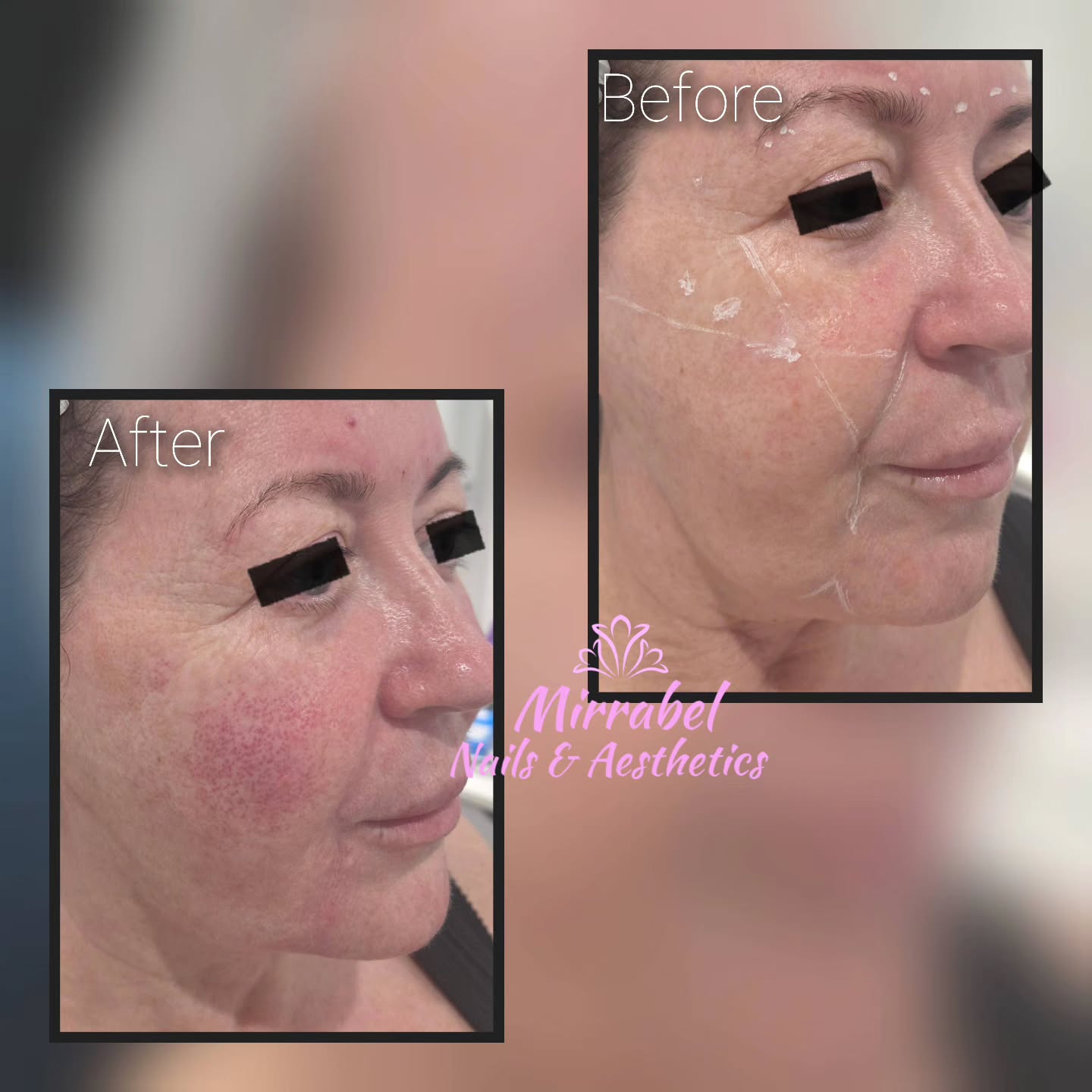 💉Full face filler rejuvenation💉
We did:
**Cheek restoration, jowls restoration adding volume to the sagging skin..
**Marrionette lines and nasiolabial lines to create softer, rejuvenated and more uplifting youthful look.
**Chin enhancement which effectively balances facial profile.
#fullfacefiller #cheekfiller #dermalfiller #timperleybeauty #faceliftfiller